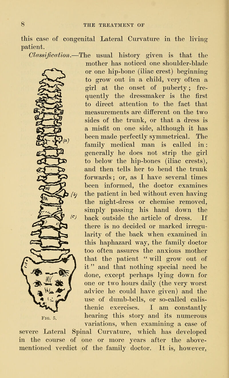 this case of congenital Lateral Curvature in the living patient. Classification.—The usual history given is that the mother has noticed one shoulder-blade or one hip-bone (iliac crest) beginning to grow out in a child, very often a girl at the onset of puberty; fre- quently the dressmaker is the first to direct attention to the fact that measurements are different on the two sides of the trunk, or that a dress is a misfit on one side, although it has been made perfectly symmetrical. The family medical man is called in: generally he does not strip the girl to below the hip-bones (iliac crests), and then tells her to bend the trunk forwards; or, as I have several times Cfiu*y been informed, the doctor examines ^>*-£r/i //,j the patient in bed without even having the night-dress or chemise removed, simply passing his hand down the back outside the article of dress. If there is no decided or marked irregu- larity of the back when examined in this haphazard way, the family doctor too often assures the anxious mother that the patient  will grow out of it and that nothing special need be done, except perhaps lying down for one or two hours daily (the very worst advice he could have given) and the use of dumb-bells, or so-called calis- thenic exercises. I am constantly hearing this story and its numerous variations, when examining a case of severe Lateral Spinal Curvature, which has developed in the course of one or more years after the above- mentioned verdict of the family doctor. It is, however, Fig.