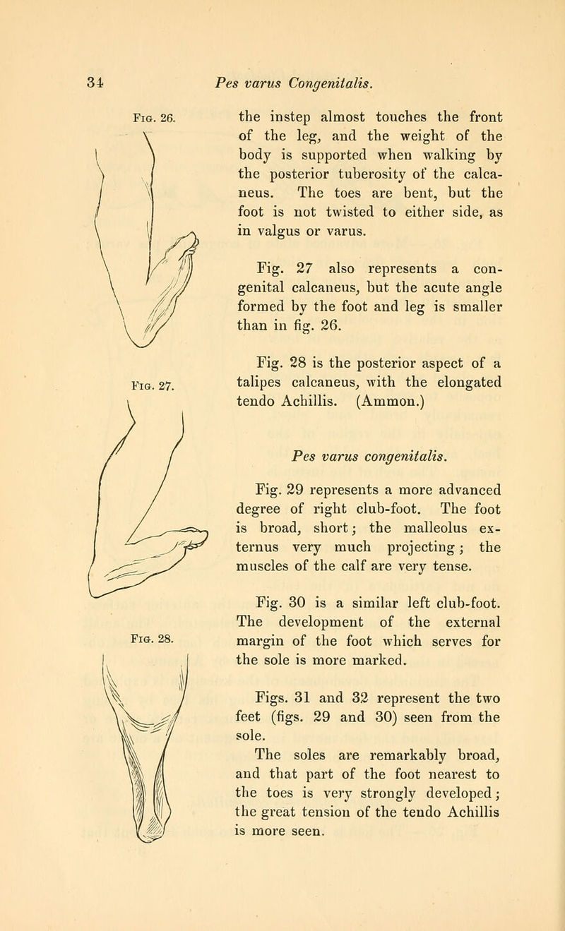 Fig. 26. Fig. 27. Fig. 28. the instep almost touches the front of the leg, and the weight of the body is supported when walking by the posterior tuberosity of the calca- neus. The toes are bent, but the foot is not twisted to either side, as in valgus or varus. Fig. 27 also represents a con- genital calcaneus, but the acute angle formed by the foot and leg is smaller than in fig. 26. Fig. 28 is the posterior aspect of a talipes calcaneus, with the elongated tendo Achillis. (Ammon.) Pes varus congenitalis. Fig. 29 represents a more advanced degree of right club-foot. The foot is broad, short; the malleolus ex- ternus very much projecting; the muscles of the calf are very tense. Fig. 30 is a similar left club-foot. The development of the external margin of the foot which serves for the sole is more marked. Figs. 31 and 32 represent the two feet (figs. 29 and 30) seen from the sole. The soles are remarkably broad, and that part of the foot nearest to the toes is very strongly developed; the great tension of the tendo Achillis is more seen.