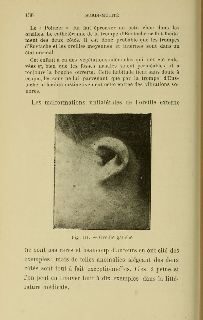 Le « Politzer » lui fait éprouver un petit choc dans les oreilles. Le cathétérisme de la trompe d'Eustache se fait facile- ment des deux côtés. Il est donc probable que les trompes d'Eustache et les oreilles moyennes et internes sont dans un état normal. Cet enfant a eu des végétations adénoïdes qui ont été enle- vées et, bien que les fosses nasales soient perméables, il a toujours la bouche ouverte. Cette habitude tient sans doute à ce que, les sons ne lui parvenant que par la trompe d'Eus- tache, il facilite instinctivement cette entrée des vibrations so- nores. Les malformations unilatérales de l'oreille externe Fis-. III. — Oreille caucbe ne sont pas rares et beaucoup d'auteurs en ont cité des exemples : mais de telles anomalies siégeant des deux côtés sont tout à fait exceptionnelles. C'est à peine si l'on peut en trouver huit à dix exemples dans la litté- rature médicale.