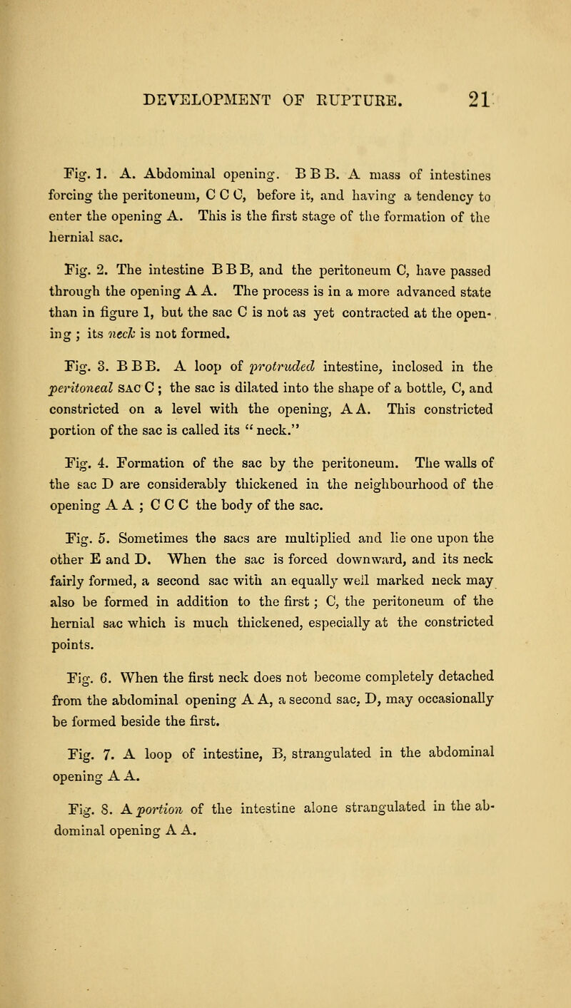 Fig. 1. A. Abdominal opening. BBB. A mass of intestines forcing the peritoneum, C C 0, before it, and having a tendency to enter the opening A. This is the first stage of the formation of the hernial sac. Fig. 2. The intestine BBB, and the peiitoneum C, have passed through the opening A A. The process is in a more advanced state than in figure 1, but the sac C is not as yet contracted at the open- ing ; its neck is not formed. Fig. 3. BBB. A loop of protruded intestine, inclosed in the peritoneal sac C ; the sac is dilated into the shape of a bottle, C, and constricted on a level with the opening, A A. This constricted portion of the sac is called its  neck. Eig. 4. Formation of the sac by the peritoneum. The walls of the sac D are considerably thickened in the neighbourhood of the opening A A ; C C C the body of the sac. Fig. 5. Sometimes the sacs are multiplied and lie one upon the other E and D. When the sac is forced downwai'd, and its neck fairly formed, a second sac with an equally well marked neck may also be formed in addition to the first; C, the peritoneum of the hernial sac which is much thickened, especially at the constricted points. Fig. 6. When the first neck does not become completely detached from the abdominal opening A A, a second sac, D, may occasionally be formed beside the first. Fig. 7. A loop of intestine, B, strangulated in the abdominal opening A A. Fig. 8. A portion of the intestine alone strangulated in the ab- dominal opening A A.