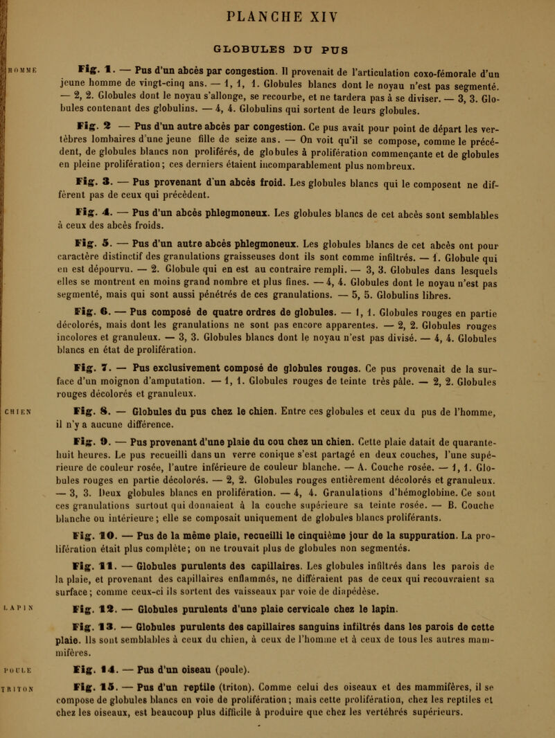 GLOBULES DU PUS ^^S' 1. — Pus d'un abcès par congestion. Il provenait de l'articulation coxo-fémorale d'un jeune homme de vingt-cinq ans. — i, 1, 1. Globules blancs dont le noyau n'est pas segmenté. — 2, 2. Globules dont le noyau s'allonge, se recourbe, et ne tardera pas à se diviser. — 3, 3. Glo- bules contenant des globulins. — 4, 4. Globulins qui sortent de leurs globules. ffîg. 2 — Pus d'un autre abcès par congestion. Ce pus avait pour point de départ les ver- tèbres lombaires d'une jeune fille de seize ans. — On voit qu'il se compose, comme le précé- dent, de globules blancs non prolifères, de globules à prolifération commençante et de globules en pleine prolifération; ces derniers étaient incomparablement plus nombreux. Fîg. 3. — Pus provenant d'un abcès froid. Les globules blancs qui le composent ne dif- fèrent pas de ceux qui précèdent. Fîg. 4. — Pus d'un abcès phlegmoneux. Les globules blancs de cet abcès sont semblables à ceux des abcès froids. Vîg. 5. — Pus d'un autre abcès phlegmoneux. Les globules blancs de cet abcès ont pour caractère distinctif des granulations graisseuses dont ils sont comme infiltrés. — 1. Globule qui en est dépourvu. — 2. Globule qui en est au contraire rempli. — 3, 3. Globules dans lesquels elles se montrent en moins grand nombre et plus fines. —4, i. Globules dont le noyau n'est pas segmenté, mais qui sont aussi pénétrés de ces granulations. — 5, 5. Globulins libres. Wlg. 6. — Pus composé de quatre ordres de globules. — 1,1. Globules rouges en partie décolorés, mais dont les granulations ne sont pas encore apparentes. — 2, 2. Globules rouges incolores et granuleux. — 3, 3. Globules blancs dont le noyau n'est pas divisé. — 4, i. Globules blancs en état de prolifération. ïig. 7. — Pus exclusivement composé de globules rouges. Ce pus provenait de la sur- face d'un moignon d'amputation. — 1,1. Globules rouges de teinte très pâle. — 2, 2. Globules rouges décolorés et granuleux. ffîg. 8. — Globules du pus chez le chien. Entre ces globules et ceux du pus de l'homme, il n'y a aucune différence. Wig' d. — Pus provenant d'une plaie du cou chez un chien. Cette plaie datait de quarante- huit heures. Le pus recueilli dans un verre conique s'est partagé en deux couches, l'une supé- rieure de couleur rosée, l'autre inférieure de couleur blanche. — A. Couche rosée. — 1,1. Glo- bules rouges en partie décolorés. — 2, 2. Globules rouges entièrement décolorés et granuleux. — 3, 3. Deux globules blancs en prolifération. — 4, 4. Granulations d'hémoglobine. Ce sont ces granulations surtout qui donnaient à la couche supérieure sa teinte rosée. — B. Couche blanche ou intérieure ; elle se composait uniquement de globules blancs proliférants. Wlg. 10. — Pus de la même plaie, recueilli le cinquième jour de la suppuration. La pro- lifération était plus complète; on ne trouvait plus de globules non segmentés. Wîg. 11. — Globules purulents des capillaires. Les globules infiltrés dans les parois de la plaie, et provenant des capillaires enflammés, ne différaient pas de ceux qui recouvraient sa surface; comme ceux-ci ils sortent des vaisseaux par voie de diapédèse, Wig. t^. — Globules purulents d'une plaie cervicale chez le lapin. Fig. 13, — Globules purulents des capillaires sanguins infiltrés dans les parois de cette plaie. Ils sont semblables à ceux du chien, à ceux de l'homme et à ceux de tous les autres mau)- mifères. ïîg. 14. — Pus d'un oiseau (poule). ffîg. 15. — Pus d'un reptile (triton). Comme celui des oiseaux et des mammifères, il se compose de globules blancs en voie de prolifération; mais cette prolifération, chez les reptiles et chez les oiseaux, est beaucoup plus difficile à produire que chez les vertébrés supérieurs.