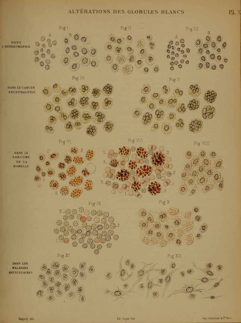 A DANS /^ ~^('^ L'HYPERTROPHIE -^ Çy W ^1^ <9 Fig.I Figll B >^ 'ttv Fig.îII DANS LE CANCER ENCEPHALOÏDE Fif IV # y-/ FigV ^ DANS LE SARCOME DE LA MAMELLE DANS LES MALADIES ARTICULAIRES #; ^ _ rig.AJi