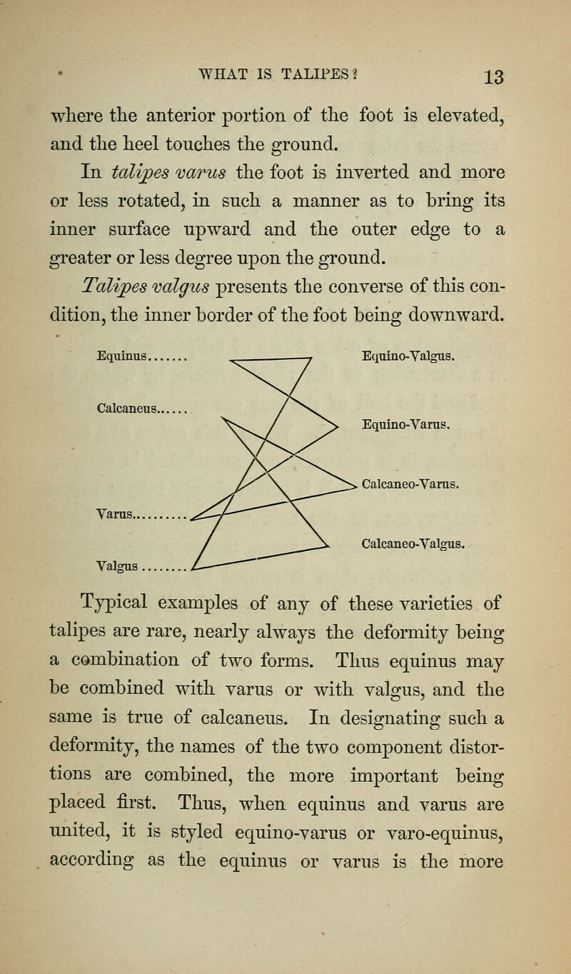 where tlie anterior portion of the foot is elevated, and the heel touches the ground. In talipes varus the foot is inverted and more or less rotated, in such a manner as to bring its inner surface upward and the outer edge to a greater or less degree upon the ground. Talipes valgus presents the converse of this con- dition, the inner border of the foot being downward. Equinus 7 Equino-Valgus. Calcaneus. ^ ^ Equino-Varus. Calcaneo-Varas. Varas. Calcaneo-Valgus. Valgus Typical examples of any of these varieties of talipes are rare, nearly always the deformity being a combination of two forms. Thus equinus may be combined with varus or with valgus, and the same is true of calcaneus. In designating such a deformity, the names of the two component distor- tions are combined, the more important being placed first. Thus, when equinus and varus are united, it is styled equino-varus or varo-equinus, according as the equinus or varus is the more