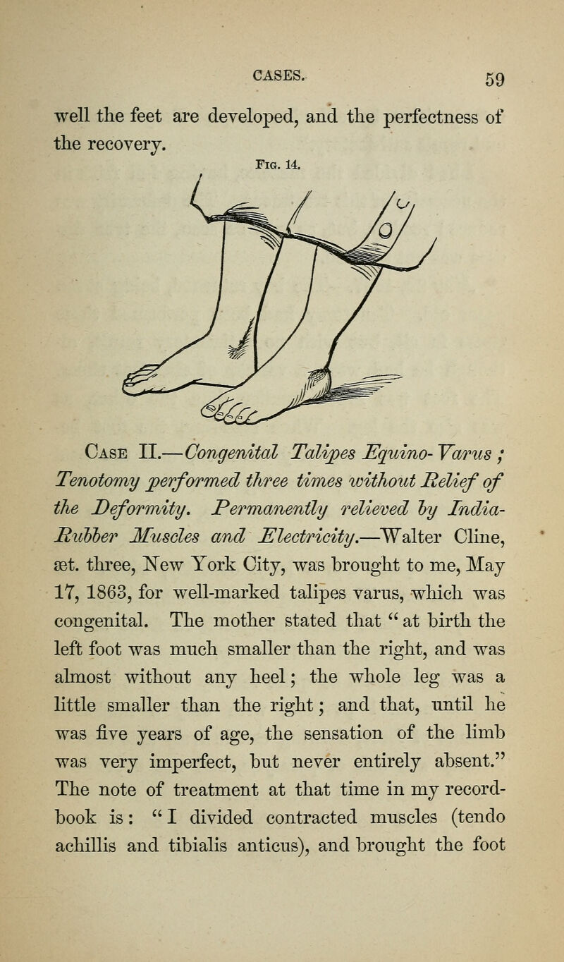 well the feet are developed, and the perfectness of the recovery. Fig. 14. Case II.—Congenital Talipes Equino- Varus ; Tenotomy performed three times without Relief of the Deformity. Permanently relieved hy India- Biibber Muscles and Electricity.—^Walter Cliiie, set. three, New York City, was brought to me, May 17, 1863, for well-marked talipes varus, which was congenital. The mother stated that  at birth the left foot was much smaller than the right, and was almost without any heel; the whole leg was a little smaller than the right; and that, until he was five years of age, the sensation of the limb was very imperfect, but never entirely absent. The note of treatment at that time in my record- book is: I divided contracted muscles (tendo achillis and tibialis anticus), and brought the foot