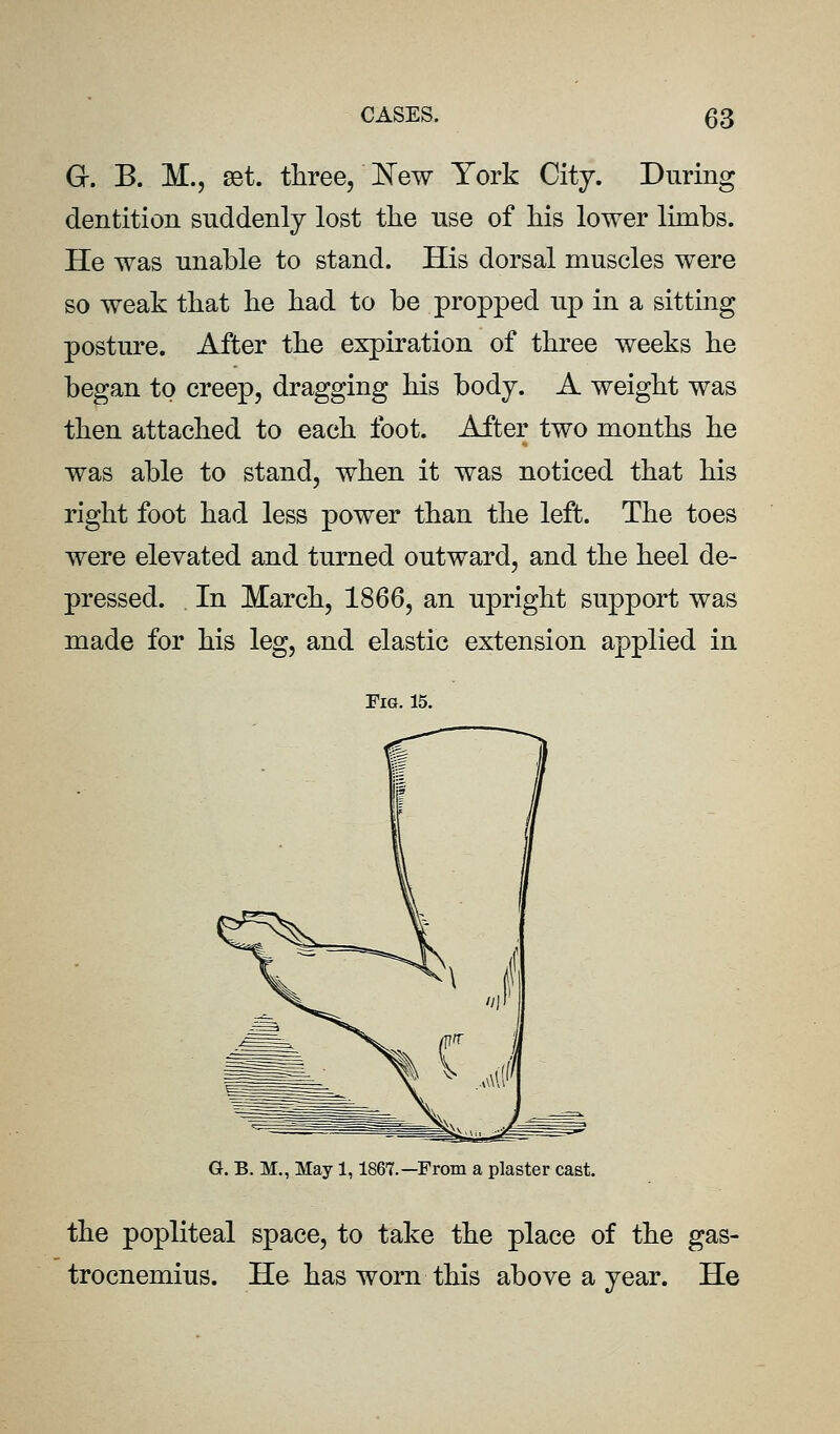 G. B. M., set. three, I^ew York City. During dentition suddenly lost the use of liis lower limbs. He was nnable to stand. His dorsal muscles were so weak that he had to be propped up in a sitting posture. After the expiration of three weeks he began to creep, dragging his body. A weight was then attached to each foot. After two months he was able to stand, when it was noticed that his right foot had less power than the left. The toes were elevated and turned outward, and the heel de- pressed. In March, 1866, an upright support was made for his leg, and elastic extension applied in Fig. 15. G. B. M., May 1,1867.—From a plaster cast. the popliteal space, to take the place of the gas- trocnemius. He has worn this above a year. He
