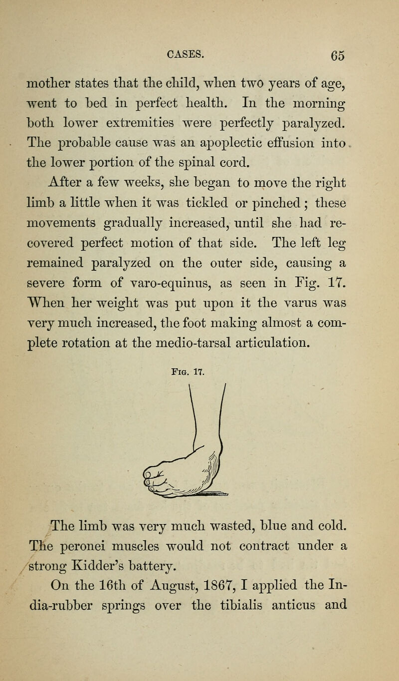 mother states tliat the child, when two years of age, went to hed in perfect health. In the morning both lower extremities were perfectly paralyzed. The probable canse was an apoplectic effusion into the lower portion of the spinal cord. After a few weeks, she began to move the right limb a little when it was tickled or pinched ; these movements gradually increased, until she had re- covered perfect motion of that side. The left leg remained paralyzed on the outer side, causing a severe form of varo-equinus, as seen in Fig. IT. When her weight was put upon it the varus was very much increased, the foot making almost a com- plete rotation at the medio-tarsal articulation. Fig. 17. The limb was very much wasted, blue and cold. The peronei muscles would not contract under a strong Kidder's battery. On the 16th of August, 1867, I applied the In- dia-rubber springs over the tibialis anticus and
