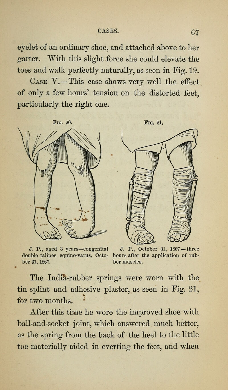 eyelet of an ordinary shoe, and attaclied above to her garter. With this slight force she could elevate the toes and walk perfectly naturally, as seen in Fig. 19. Case Y.—This case shows very well the effect of only a few hours' tension on the distorted feet, particularly the right one. Fig. 20. Fig. 21. J, P., aged 3 years—congenital J. P., October 31, 1867 — three double talipes equino-varus, Octo- hours after the application of rub- ber 31,1867. ber muscles. The Indi^-rubber springs were worn with the tin splint and adhesive plaster, as seen in Fig. 21, for two months. ' After this time he wore the improved shoe with ball-and-socket joint, which answered much better, as the spring from the back of the heel to the little toe materially aided in everting the feet, and when