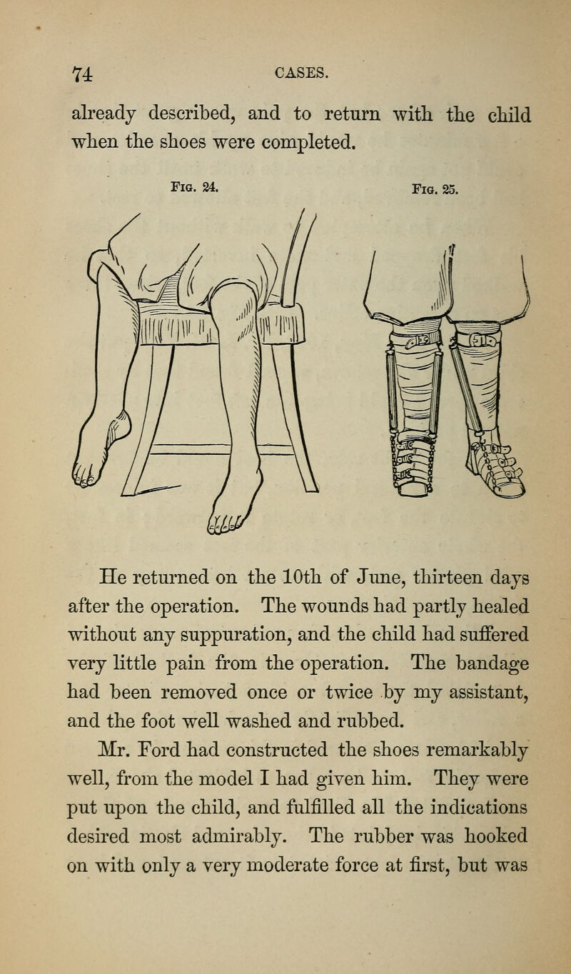 already describedj and to return with tlie child when the shoes were completed. Fia. 24. Fig. 25. He returned on the 10th of June, thirteen days after the operation. The wounds had partly healed without any suppuration, and the child had suffered very little pain from the operation. The bandage had been removed once or twice by my assistant, and the foot well washed and rubbed. Mr. Ford had constructed the shoes remarkably well, from the model I had given him. They were put upon the child, and fulfilled all the indications desired most admirably. The rubber was hooked on with only a very moderate force at first, but was