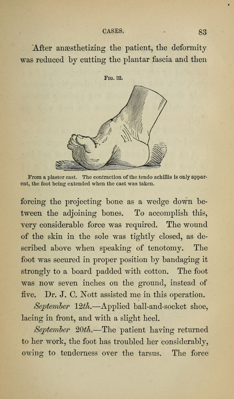 After anoestlietizing the patient, the deformity was reduced by cutting the plantar fascia and then Fig. 32. From a plaster cast. The contraction of the tendo achillis is only appar- ent, the foot being extended when the cast was taken. forcing the projecting bone as a wedge down be- tween the adjoining bones. To accomplish tliis, very considerable force was required. The wound of the skin in the sole was tightly closed, as de- scribed above when speaking of tenotomy. The foot was secured in proper position by bandaging it strongly to a board padded with cotton. The foot was now seven inches on the ground, instead of five. Dr. J. C. E'ott assisted me in this operation. September 12th.—^Applied ball-and-socket shoe, lacing in front, and with a slight heel. September %)th.—The patient having returned to her work, the foot has troubled her considerably, owing to tenderness over the tarsus. The force