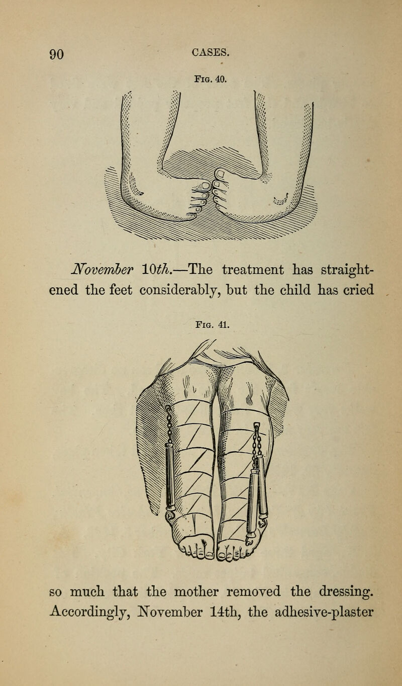 Novernher lOtJi.—The treatment has straight- ened the feet considerably, but the child has cried Fig. 41. SO much that the mother removed the dressing. Accordingly, November 14th, the adhesive-plaster