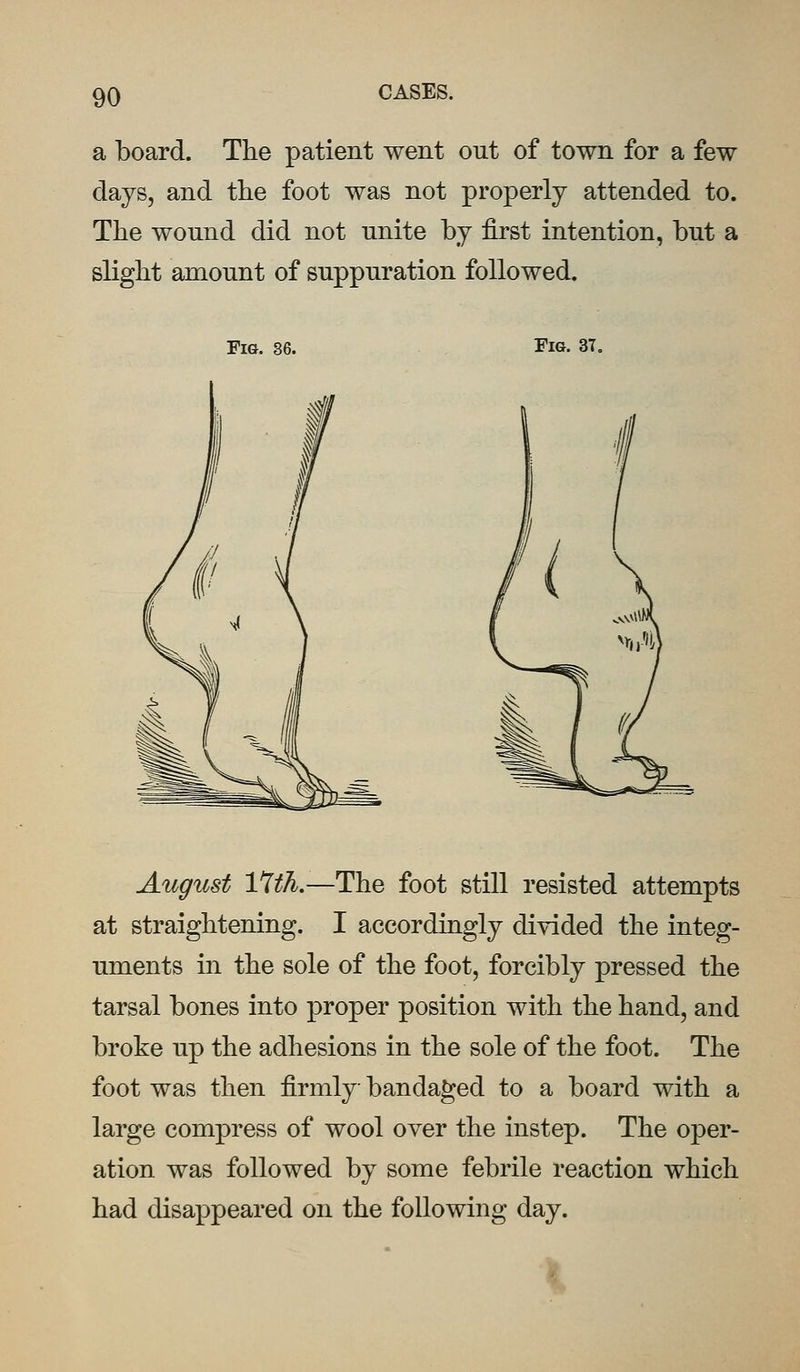 a board. The patient went ont of town for a few days, and the foot was not properly attended to. The wound did not unite by first intention, but a slight amount of suppuration followed. Fig. 36. Fig. 37. August 17th.—The foot still resisted attempts at straightening. I accordingly divided the integ- uments in the sole of the foot, forcibly pressed the tarsal bones into proper position with the hand, and broke up the adhesions in the sole of the foot. The foot was then firmly bandaged to a board with a large compress of wool over the instep. The oper- ation was followed by some febrile reaction which had disappeared on the following day.