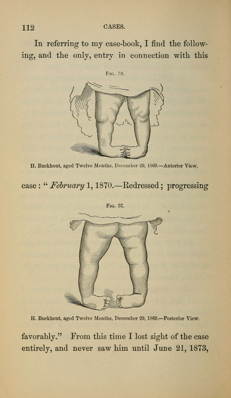 In referring to my case-book, I find the follow- ing, and the only, entry in connection with this Fig. o6. H. Buckhout, aged Twelve Months, December 29, 1S69.—Anterior View. case :  February 1,1870.—Eedressed; progressing Fig. 57. H. Buckhout, aged Twelve Months, December 29,1869.—Posterior View. favorably. From this time I lost sight of the case entirely, and never saw him until June 21, 1873,