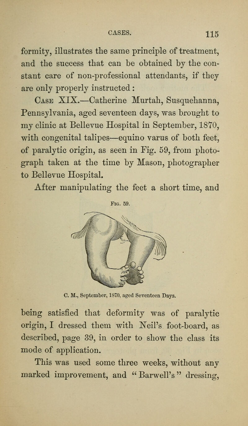 formity, illustrates the same principle of treatment, and the success that can be obtained by the con- stant care of non-professional attendants, if they are only properly instructed: Case XIX.—Catherine Murtah, Susquehanna, Pennsylvania, aged seventeen days, was brought to my clinic at Bellevue Hospital in September, 1870, with congenital talipes—equino varus of both feet, of paralytic origin, as seen in Fig. 59, from photo- graph taken at the time by Mason, photographer to Bellevue Hospital. After manipulating the feet a short time, and Fig. 59. C. M., September, 1870, aged Seventeen Days. being satisfied that deformity was of paralytic origin, I dressed them with Neil's foot-board, as described, page 39, in order to show the class its mode of application. This was used some three weeks, without any marked improvement, and Barwell's dressing,