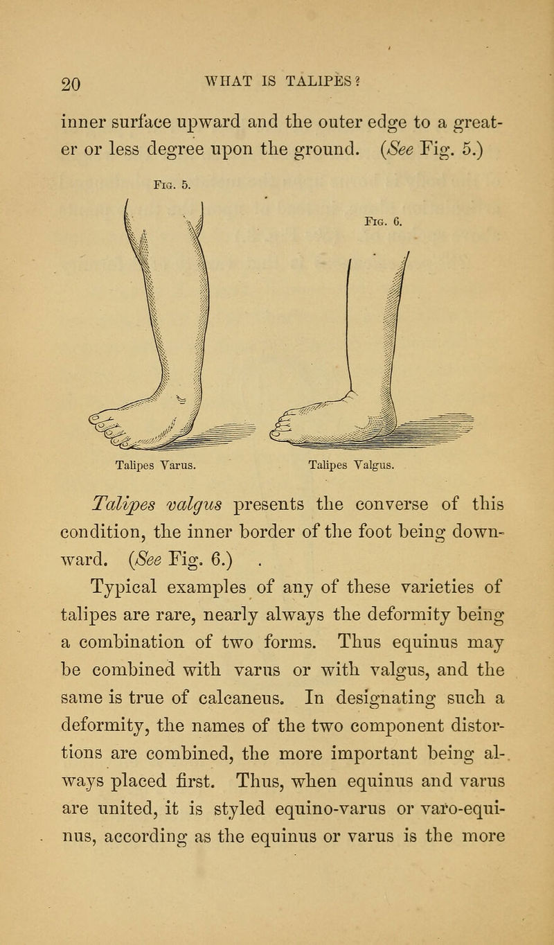 inner surface upward and the outer edge to a great- er or less degree upon the ground. (See Fig. 5.) Fig. 5. Fig. G. Talipes Varus. Talipes Valgus Talipes valgus presents the converse of this condition, the inner border of the foot being down- ward. (See Fig. 6.) Typical examples of any of these varieties of talipes are rare, nearly always the deformity being a combination of two forms. Thus equinus may be combined with varus or with valgus, and the same is true of calcaneus. In designating such a deformity, the names of the two component distor- tions are combined, the more important being al-. ways placed first. Thus, when equinus and varus are united, it is styled equino-varus or varo-equi- nus, according as the equinus or varus is the more