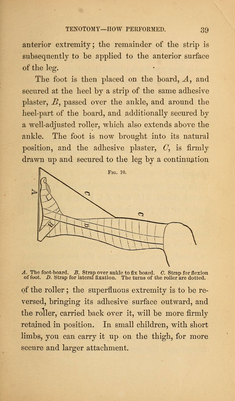 anterior extremity; the remainder of the strip is subsequently to be applied to the anterior surface of the leg. The foot is then placed on the board, A, and secured at the heel by a strip of the same adhesive plaster, B, passed over the ankle, and around the heel-part of the board, and additionally secured by a well-adjusted roller, which also extends above the ankle. The foot is now brought into its natural position, and the adhesive plaster, C, is firmly drawn up and secured to the leg by a continuation Fig. 10. A. The foot-board. B. Strap over ankle to fix board, of foot. D. Strap for lateral fixation. The turns of the roller are dotted. C. Strap for flexion of the roller; the superfluous extremity is to be re- versed, bringing its adhesive surface outward, and the roller, carried back over it, will be more firmly retained in position. In small children, with short limbs, you can carry it up on the thigh, for more secure and larger attachment.