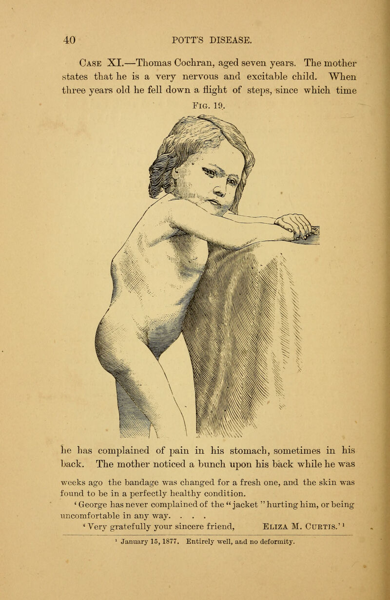 Case XI.—Thomas Cocliran, aged seven years. The mother states that he is a very nervous and excitable child. When three years old he fell down a flight of steps, since which time Fig. 19. he has complained of i:)ain in his stomach, sometimes in his hack. The mother noticed a bunch upon his back while he was weeks ago the bandage was changed for a fresh one, and the skin was found to be in a perfectly healthy condition. ' George has never complained of the  jacket  hurting him, or being uncomfortable in any way. . . . ' Very gratefully your sincere friend, Eliza M. Curtis.' ' ^ January 15,1877. Entirely well, and no deformity.