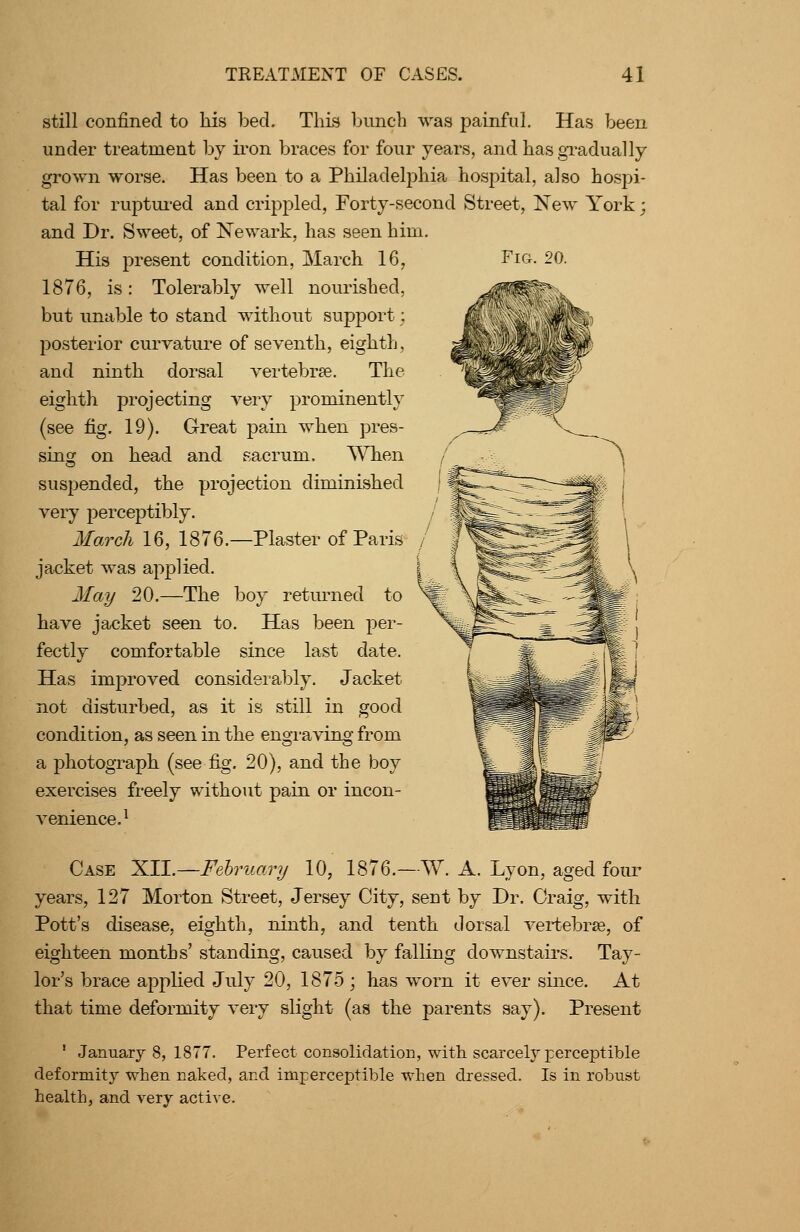 Fig. 20. still confined to his bed. This hunch was painful. Has been under treatment by iron braces for four years, and hasgTadually grown worse. Has been to a Philadelphia hospital, also hospi- tal for ruptui-ed and crippled, Forty-second Street, New York; and Dr. Sweet, of Newark, has seen him. His present condition, March 16, 1876, is: Tolerably well nourished, but unable to stand without support; posterior curvature of seventh, eighth, and ninth dorsal vertebrae. The eighth projecting very prominently (see fig. 19). Great pain when pres- sing on head and sacrum. When suspended, the projection diminished very perceptibly. March 16, 1876.—Plaster of Paris jacket was applied. 2Iay 20.—The boy retm-ned to have jacket seen to. Has been per- fectly comfortable since last date. Has improved considerably. Jacket not disturbed, as it is still in good condition, as seen in the engi-aving from a photograph (see fig. 20), and the boy exercises freely without pain or incon- venience.^ Case XII.—Fehruary 10, 1876.—W. A. Lyon, aged foiu- years, 127 Morton Street, Jersey City, sent by Dr. Craig, with Pott's disease, eighth, ninth, and tenth dorsal vertebrie, of eighteen months' standing, caused by falling downstairs. Tay- lor's brace apphed July 20, 1875 ; has worn it ever since. At that time deformity very slight (as the parents say). Present ' January 8, 1877. Perfect consolidation, with, scarcely perceptible deformity when naked, and imperceptible when dressed. Is in robust health, and very active.