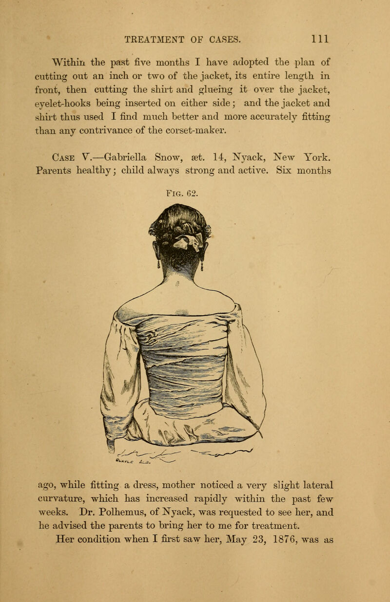 Within the past five months I have adopted the plan of cutting out an inch or two of the jacket, its entire length in front, then cutting the shh^t and glueing it over the jacket, eyelet-hooks being inserted on either side; and the jacket and shirt thus used I find much better and more acciu'ately fitting than any contriA^ance of the corset-maker. Case V.—Gabriella Snow, set. 14, jSTyack, 'New York. Parents healthy; child always strong and active. Six months Fig. 62. ago, while fitting a dress, mother noticed a very slight lateral curvature, which has increased rapidly within the past few weeks. Dr. Polhemus, of Nyack, was requested to see her, and he advised the parents to bring her to me for treatment. Her condition when I first saw her, May 23, 1876, was as