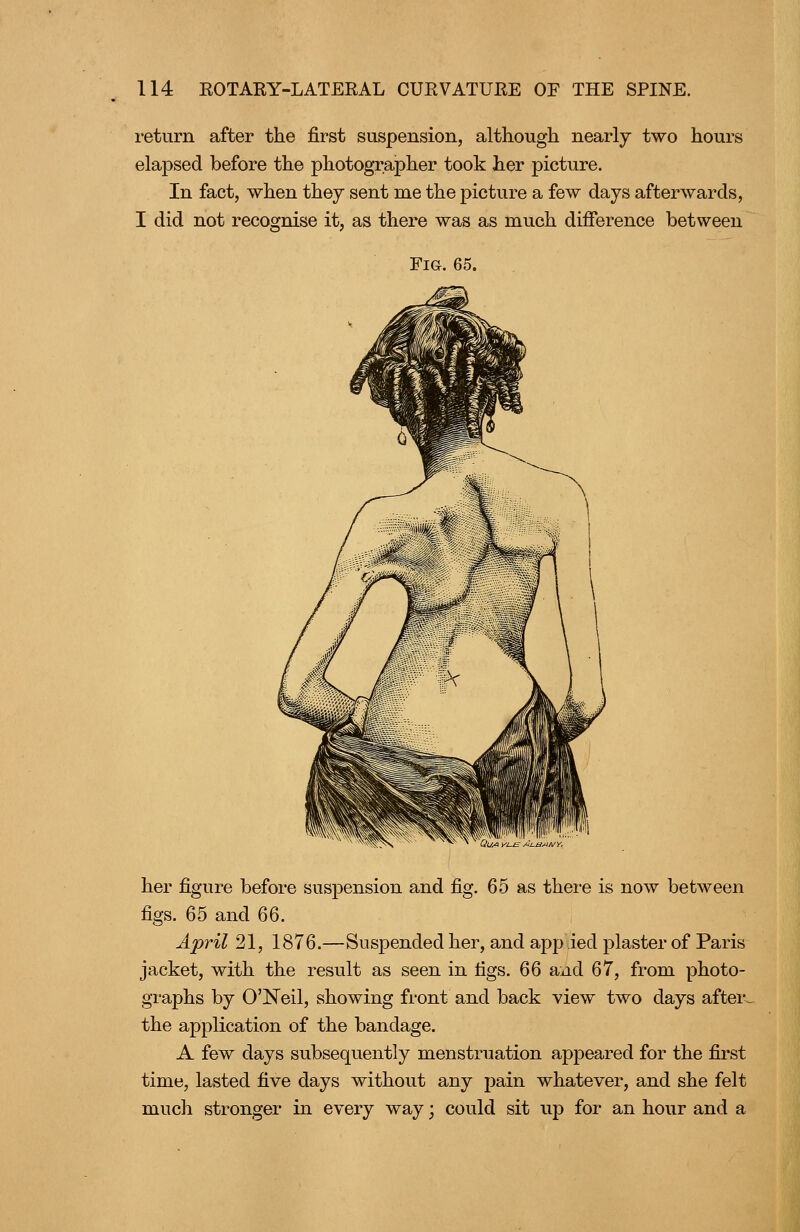 I'eturn after the first suspension, although nearly two hours elapsed before the photographer took her picture. In fact, when they sent me the picture a few days afterwards, I did not recognise it, as there was as much difference between Fig. 65. her figure before suspension and fig. 65 as there is now between figs. 65 and 66. April 21, 1876.—Suspended her, and app ied plaster of Paris jacket, with the result as seen in tigs. QQ and 67, from photo- graphs by CNeil, showing front and back view two days after^ the application of the bandage. A few days subsequently menstruation appeared for the first time, lasted five days without any pain whatever, and she felt much stronger in every way; could sit up for an hour and a