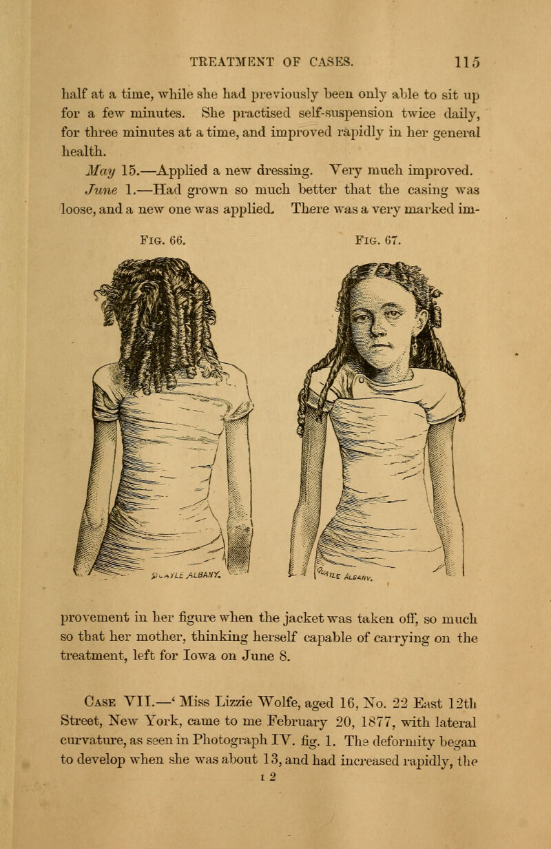 half at a time, while she had previously been only able to sit up for a few minutes. She practised self-suspension twice daily, for three minutes at a time, and improved rapidly in her general health. May 15.—AppKed a new dressing. Very much improved. June 1.—Had grown so much better that the casing was loose, and a new one was applied. There was a very marked im- FiG. 66. Fig. 67, j^^r.iLcA-ti'^Hy-. provement in her figure when the jacket was taken off, so much so that her mother, thinking herself capable of carrying on the treatment, left for Iowa on June 8. Case VII.—' Miss Lizzie Wolfe, aged 16, No. 22 East 12th Street, New York, came to me February 20, 1877, ^ith lateral curvature, as seen in Photograph TV. fig. 1. The deformity began to develop when she was about 13, and had increased rapidly, the i2