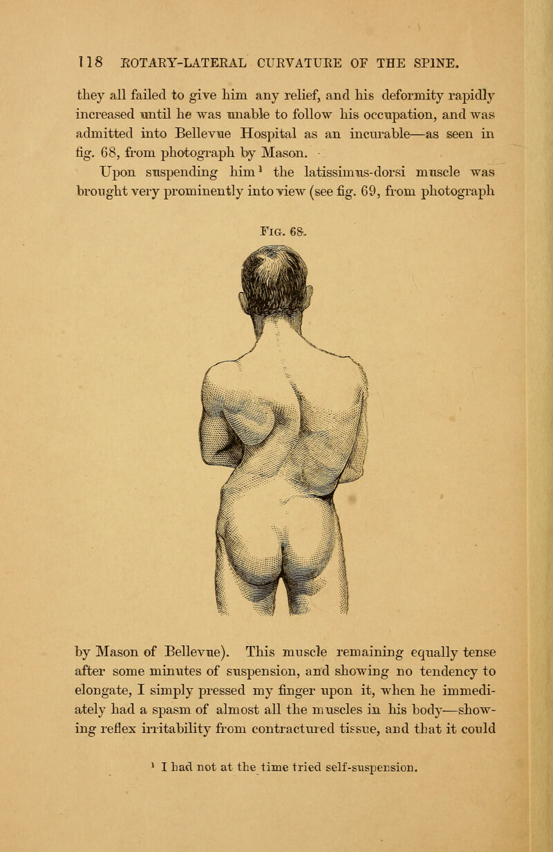 they all failed to give him any relief, and his deformity rapidly increased nntil he was unable to follow his occupation, and was admitted into Bellevue Hospital as an incurable—as seen in fig. 68, from i^hotograph by Mason. ■ Upon suspending him* the latissimns-dorsi muscle was brought very prominently into view (see fig. 69, from photograph Fig. 6&, by Mason of Bellevue). This muscle remaining equally tense after some minutes of suspension, and showing no tendency to elongate, I simply pressed my finger upon it, when he immedi- ately had a spasm of almost all the muscles in his body-—show- ing reflex irritability from contractured tissue, and that it could I had not at the time tried self-susjpensiori.