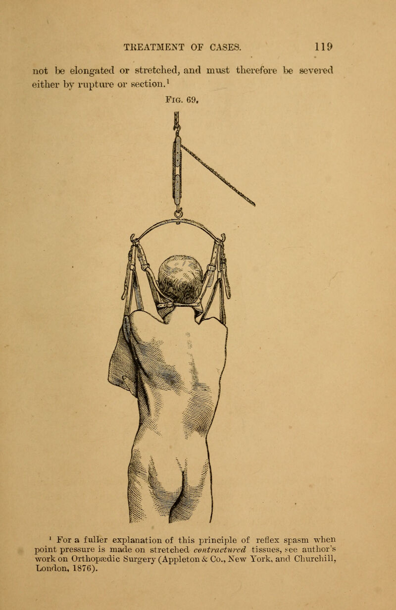 not be elongated or stretched^ and must therefore be severed either by rupture or section.^ Fig. 69, 1 For a fuller explanation of this principle of reflex spasm when point pressure is made on stretched contractwed tissues, see author's work on Orthopaedic Surgery (Appleton & Co., New York, and Churchill. London, 1876).