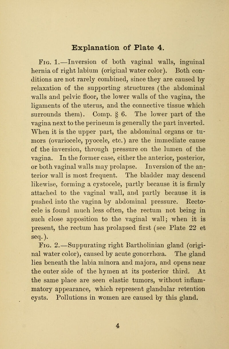 Fig. 1.—Inversion of both vaginal walls, inguinal hernia of right labium (original water color). Both con- ditions are not rarely combined, since they are caused by relaxation of the supporting structures (the abdominal walls and pelvic floor, the lower walls of the vagina, the ligaments of the uterus, and the connective tissue which surrounds them). Comp. g 6. The lower part of the vagina next to the perineum is generally the part inverted. When it is the upper part, the abdominal organs or tu- mors (ovariocele, pyocele, etc.) are the immediate cause of the inversion, through pressure on the lumen of the vagina. In the former case, either the anterior, posterior, or both vaginal walls may prolapse. Inversion of the an- terior wall is most frequent. The bladder may descend likewise, forming a cystocele, partly because it is firmly attached to the vaginal wall, and partly because it is pushed into the vagina by abdominal pressure. Eecto- cele is found much less often, the rectum not being in such close apposition to the vaginal wall; when it is present, the rectum has prolapsed first (see Plate 22 et seq.). Fig. 2.—Suppurating right Bartholinian gland (origi- nal water color), caused by acute gonorrhoea. The gland lies beneath the labia minora and majora, and opens near the outer side of the hymen at its posterior third. At the same place are seen elastic tumors, without inflam- matory appearance, which represent glandular retention cysts. Pollutions in women are caused by this gland.