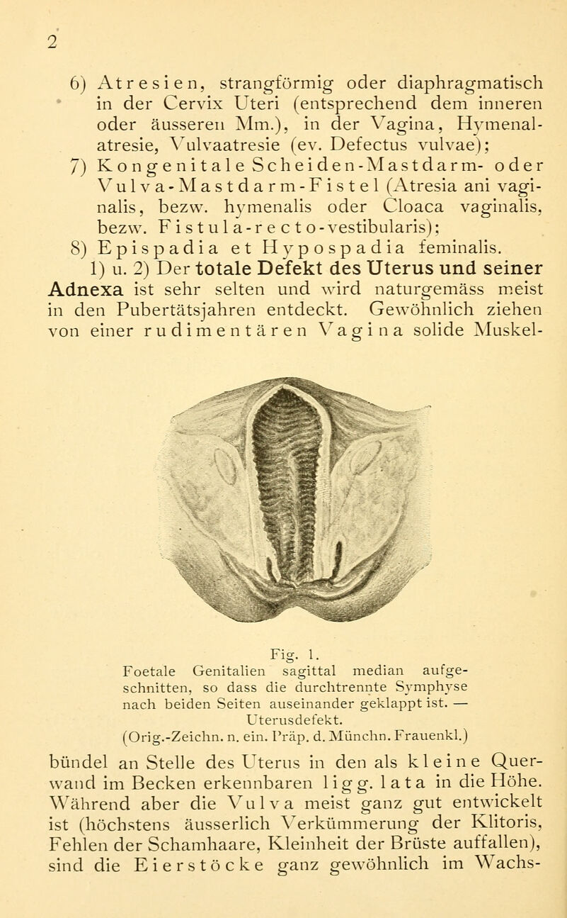 6) Atresien, strangförmig oder diaphragmatisch in der Cervix Uteri (entsprechend dem inneren oder äusseren Mm.), in der Vagina, Hvmenal- atresie, Vulvaatresie (ev. Defectus vulvae); 7) Kongenitale Scheiden-Mastdarm- oder Vulva-Mastdarm-Fistel (Atresia ani vagi- nalis, bezw. hymenalis oder Cloaca vaginalis, bezw. Fistula-recto-vestibularis); 8) Epispadia et Hypospadia feminalis. 1) u. 2) Der totale Defekt des Uterus und seiner Adnexa ist sehr selten und wird naturgemäss m>eist in den Pubertätsjahren entdeckt. Gewöhnlich ziehen von einer rudimentären \^agina solide Muskel- Fig. 1. Foetale Genitalien sagittal median aufge- schnitten, so dass die durchtrennte Symphyse nach beiden Seiten auseinander geklappt ist. — Uterusdefekt. (Orig.-Zeichn. n. ein. Träp. d. Münchn. Frauenkl.) bündel an Stelle des Uterus in den als kleine Quer- wand im Becken erkennbaren liecg'. lata in die Höhe. Während aber die Vulva meist ganz gut entwickelt ist (höchstens äusserlich \^erkümmerung der KUtoris, Fehlen der Schamhaare, Kleinheit der Brüste auffaUen), sind die Eierstöcke ganz gewöhnUch im Wachs-