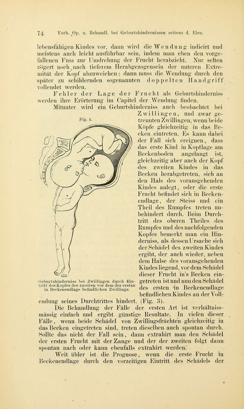 lebensfäliig-en Kindes vor, dann wird die Wendung- indicirt und meistens auch leicht ausführbar sein, indem man eben den vorge- fallenen Fuss zur Umdrehung der Frucht herabzieht. Nur selten zögert noch.nach tieferem Herabgezog'ensein der unteren Extre- mität der Kopf abzuweichen; dann muss die Wendung durch den später zu schildernden sogenannten doppelten Handgriff vollendet werden. Fehler der Lage der Frucht als Geburtshinderniss werden ihre Erörterung im Capitel der Wendung finden. Mitunter wird ein Geburtshinderniss auch beobachtet bei Zwillingen, und zwar ge- trennten Zwillingen, wenn beide Köpfe gleichzeitig in das Be- cken eintreten. Es kann dabei der Fall sich ereignen, dass das erste Kind in Koptlage am Beckenboden angelangt ist, gleichzeitig aber auch der Kopf des zweiten Kindes in das Becken herabgetreten, sich an den Hals des vorausgehenden Kindes anlegt, oder die erste Frucht befindet sich in Becken- endlage, der Steiss und ein Theil des Rumpfes treten un- behindert durch. Beim Durch- tritt des oberen Theiles des Rumpfes und des nachfolgenden Kopfes bemerkt man ein Hin- derniss, als dessen Ursache sich der Schädel des zweiten Kindes ergibt, der auch wieder, neben dem Halse des vorausgehenden Kindes liegend, vor dem Schädel dieser Frucht in's Becken ein- getreten ist und mm den Schädel des ersten in Beckenendlage befindlichen Kindes an der Voll- endung seines Durchtrittes hindert. (Fig. 3). Die Behandlung der Fälle der ersten Art ist verhältuiss- mässig einfach und ergibt günstige Resultate. In vielen dieser Fälle, wenn beide Schädel von Zwillingsfrüchten gleichzeitig in das Becken eingetreten sind, treten dieselben auch spontan durch. Sollte das nicht der Fall sein, dann extrahirt man den Schädel der ersten Frucht mit der Zange und der der zweiten folgt dann spontan nach oder kann ebenfalls extrahirt werden. Weit übler ist die Prognose, wenn die erste Frucht in Beckenendlage durch den vorzeitigen Eintritt des Schädels der Geburtshinderniss bei Zwillingen durch Ein- tritt des Kopfes des zweiten vor dem des ersten in Beckenendlage befindlichen Zwillings.