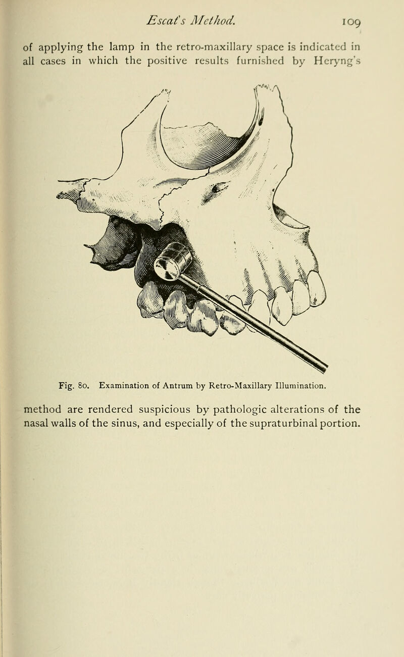 Escat's Method. of applying the lamp in the retro-maxillary space is indicated in all cases in which the positive results furnished by Heryng's Fig. 80. Examination of Antrum by Retro-Maxillary Illumination. method are rendered suspicious by pathologic alterations of the nasal walls of the sinus, and especially of the supraturbinal portion.