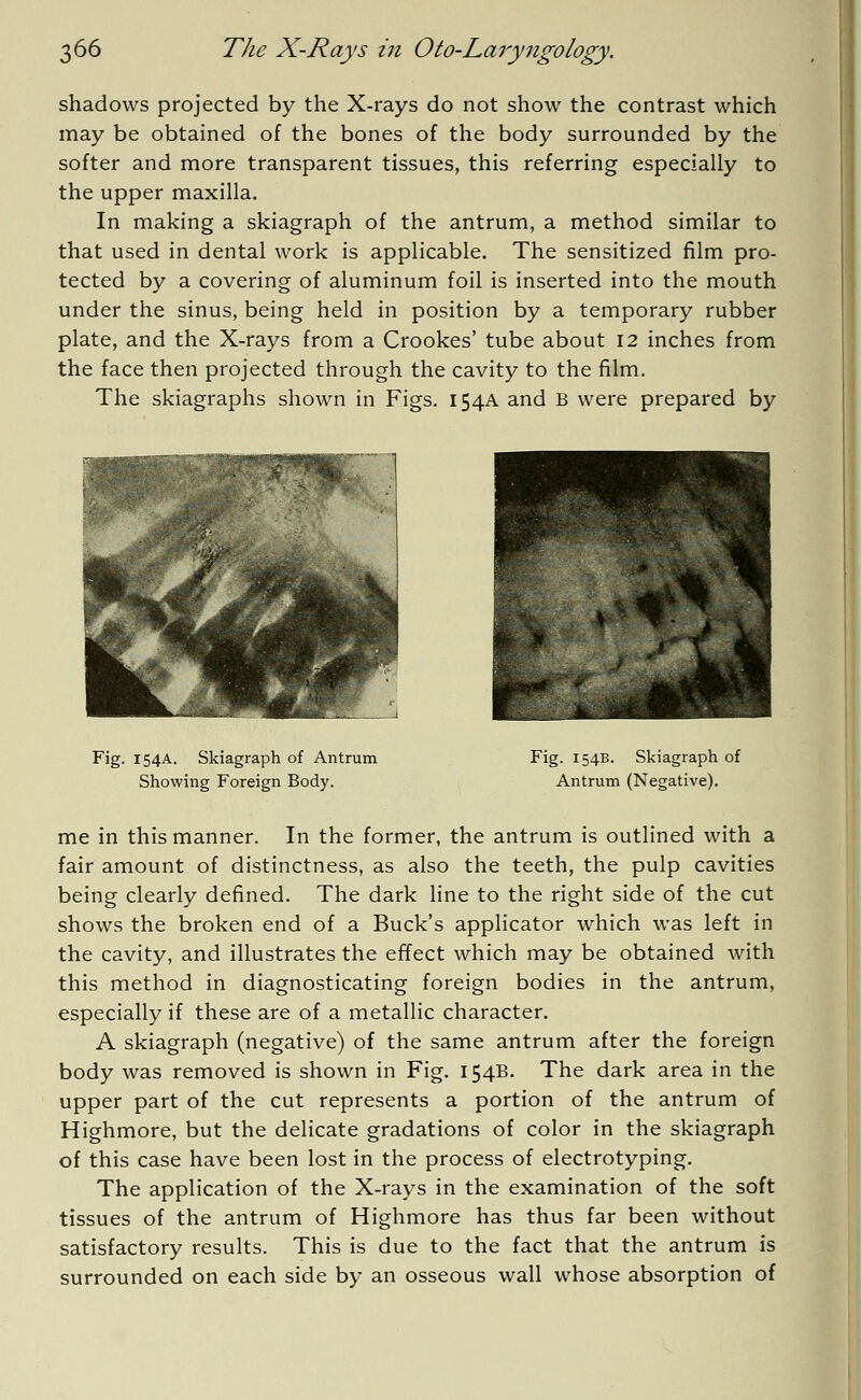 shadows projected by the X-rays do not show the contrast which may be obtained of the bones of the body surrounded by the softer and more transparent tissues, this referring especially to the upper maxilla. In making a skiagraph of the antrum, a method similar to that used in dental work is applicable. The sensitized film pro- tected by a covering of aluminum foil is inserted into the mouth under the sinus, being held in position by a temporary rubber plate, and the X-rays from a Crookes' tube about 12 inches from the face then projected through the cavity to the film. The skiagraphs shown in Figs. 154A and B were prepared by Fig. 154A. Skiagraph of Antrum Showing Foreign Body. Fig. 154B. Skiagraph of Antrum (Negative). me in this manner. In the former, the antrum is outlined with a fair amount of distinctness, as also the teeth, the pulp cavities being clearly defined. The dark line to the right side of the cut shows the broken end of a Buck's applicator which was left in the cavity, and illustrates the effect which may be obtained with this method in diagnosticating foreign bodies in the antrum, especially if these are of a metallic character. A skiagraph (negative) of the same antrum after the foreign body was removed is shown in Fig. 154B. The dark area in the upper part of the cut represents a portion of the antrum of Highmore, but the delicate gradations of color in the skiagraph of this case have been lost in the process of electrotyping. The application of the X-rays in the examination of the soft tissues of the antrum of Highmore has thus far been without satisfactory results. This is due to the fact that the antrum is surrounded on each side by an osseous wall whose absorption of