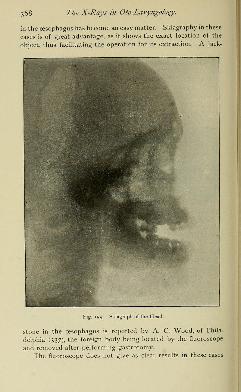 in the oesophagus has become an easy matter. Skiagraphy in these cases is of great advantage, as it shows the exact location of the object, thus facilitating the operation for its extraction. A jack- Fig- 155- Skiagraph of the Head. stone in the oesophagus is reported by A. C. Wood, of Phila- delphia (537), the foreign body being located by the fluoroscope and removed after performing gastrotomy. The fluoroscope does not give as clear results in these cases