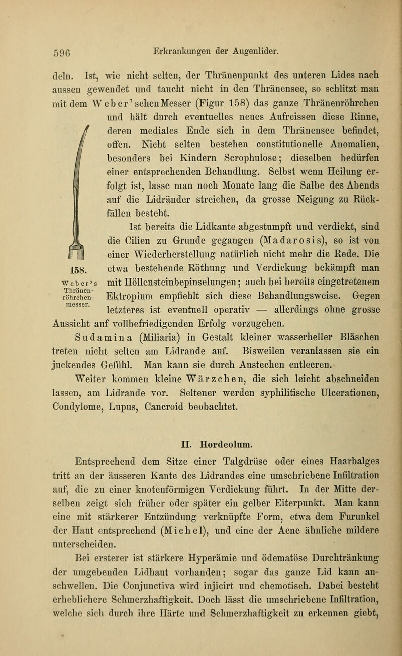 dein. Ist, wie nicht selten, der Thränenpunkt des unteren Lides nach aussen gewendet und taucht nicht in den Thränensee, so schlitzt man mit dem Weber'sehen Messer (Figur 158) das ganze Thränenröhrchen und hält durch eventuelles neues Aufreissen diese Rinne, deren mediales Ende sich in dem Thränensee befindet, offen. Nicht selten bestehen constitutionelle Anomalien, besonders bei Kindern Scrophulose; dieselben bedürfen einer entsprechenden Behandlung. Selbst wenn Heilung er- folgt ist, lasse man noch Monate lang die Salbe des Abends auf die Lidränder streichen, da grosse Neigung zu Rück- fällen besteht. Ist bereits die Lidkante abgestumpft und verdickt, sind die Cilien zu Grunde gegangen (Madarosis), so ist von einer Wiederherstellung natürlich nicht mehr die Rede. Die 158. etwa bestehende Röthung und Verdickung bekämpft man web er' s mit Höllensteinbepinselungeii; auch bei bereits eingetretenem röhrchen- Ektropium empfiehlt sich diese Behandlungsweise. Gegen letzteres ist eventuell operativ — allerdings ohne grosse Aussicht auf vollbefriedigenden Erfolg vorzugehen. Sudamina (Miliaria) in Gestalt kleiner wasserheller Bläschen treten nicht selten am Lidrande auf. Bisweilen veranlassen sie ein juckendes Gefühl. Man kann sie durch Anstechen entleeren. Weiter kommen kleine Wärzchen, die sich leicht abschneiden lassen, am Lidrande vor. Seltener werden syphilitische Ulcerationen, Condylome, Lupus, Cancroid beobachtet. II. Hordeolum. Entsprechend dem Sitze einer Talgdrüse oder eines Haarbalges tritt an der äusseren Kante des Lidrandes eine umschriebene Infiltration auf, die zu einer knotenförmigen Verdickung führt. In der Mitte der- selben zeigt sich früher oder später ein gelber Eiterpunkt. Man kann eine mit stärkerer Entzündung verknüpfte Form, etwa dem Furunkel der Haut entsprechend (Michel), und eine der Acne ähnliche mildere unterscheiden. Bei ersterer ist stärkere Hyperämie und ödematöse Durchtränkung der umgebenden Lidhaut vorhanden; sogar das ganze Lid kann an- schwellen. Die Conjunctiva wird injicirt und chemotisch. Dabei besteht erheblichere Schmerzhaft!gkeit. Doch lässt die umschriebene Infiltration, welche sich durch ihre Härte und Schmerzhaftigkeit zu erkennen giebt,