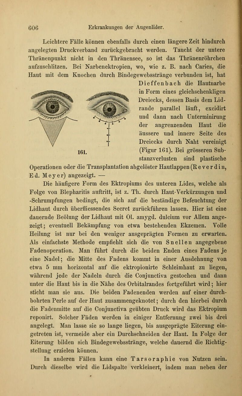 161. Leichtere Fälle können ebenfalls durch einen längere Zeit hindurch angelegten Druckverband zurückgebracht werden. Taucht der untere Thränenpunkt nicht in den Thränensee, so ist das Thränenröhrchen aufzuschlitzen. Bei Narbenektropien, wo, wie z. B. nach Caries, die Haut mit dem Knochen durch Bindegewebsstränge verbunden ist, hat Dieffenbach die Hautnarbe in Form eines gleichschenkligen Dreiecks, dessen Basis dem Lid- rande parallel läuft, excidirt und dann nach Unterminirung der angrenzenden Haut die äussere und innere Seite des Dreiecks durch Naht vereinigt (Figur 161). Bei grösseren Sub- stanzverlusten sind plastische Operationen oder die Transplantation abgelöster Hautlappen (R e v e r d i n, Ed. Meyer) angezeigt. — Die häufigere Form des Ektropiums des unteren Lides, welche als Folge von Blepharitis auftritt, ist z. Th. durch Haut-Verkürzungen und -Schrumpfungen bedingt, die sich auf die beständige Befeuchtung der Lidhaut durch überfliessendes Secret zurückführen lassen. Hier ist eiue dauernde Beölung der Lidhaut mit Ol. amygd. dulcium vor Allem ange- zeigt; eventuell Bekämpfung von etwa bestehenden Ekzemen. Volle Heilung ist nur bei den weniger ausgeprägten Formen zu erwarten. Als einfachste Methode empfiehlt sich die von Sneilen angegebene Fadenoperation. Man führt durch die beiden Enden eines Fadens je eine Nadel; die Mitte des Fadens kommt in einer Ausdehnung von etwa 5 mm horizontal auf die ektropionirte Schleimhaut zu liegen, während jede der Nadeln durch die Conjunctiva gestochen und dann unter die Haut bis in die Nähe des Orbitalrandes fortgeführt wird; hier sticht man sie aus. Die beiden Fadenenden werden auf einer durch- bohrten Perle auf der Haut zusammengeknotet; durch den hierbei durch die Fadenmitte auf die Conjunctiva geübten Druck wird das Ektropium reponirt. Solcher Fäden werden in einiger Entfernung zwei bis drei angelegt. Man lasse sie so lange liegen, bis ausgeprägte Eiterung ein- getreten ist, vermeide aber ein Durchschneiden der Haut. In Folge der Eiterung bilden sich Bindegewebsstränge, welche dauernd die Richtig- stellung erzielen können. In anderen Fällen kann eine Tarsoraphie von Nutzen sein. Durch dieselbe wird die Lidspalte verkleinert, indem man neben der