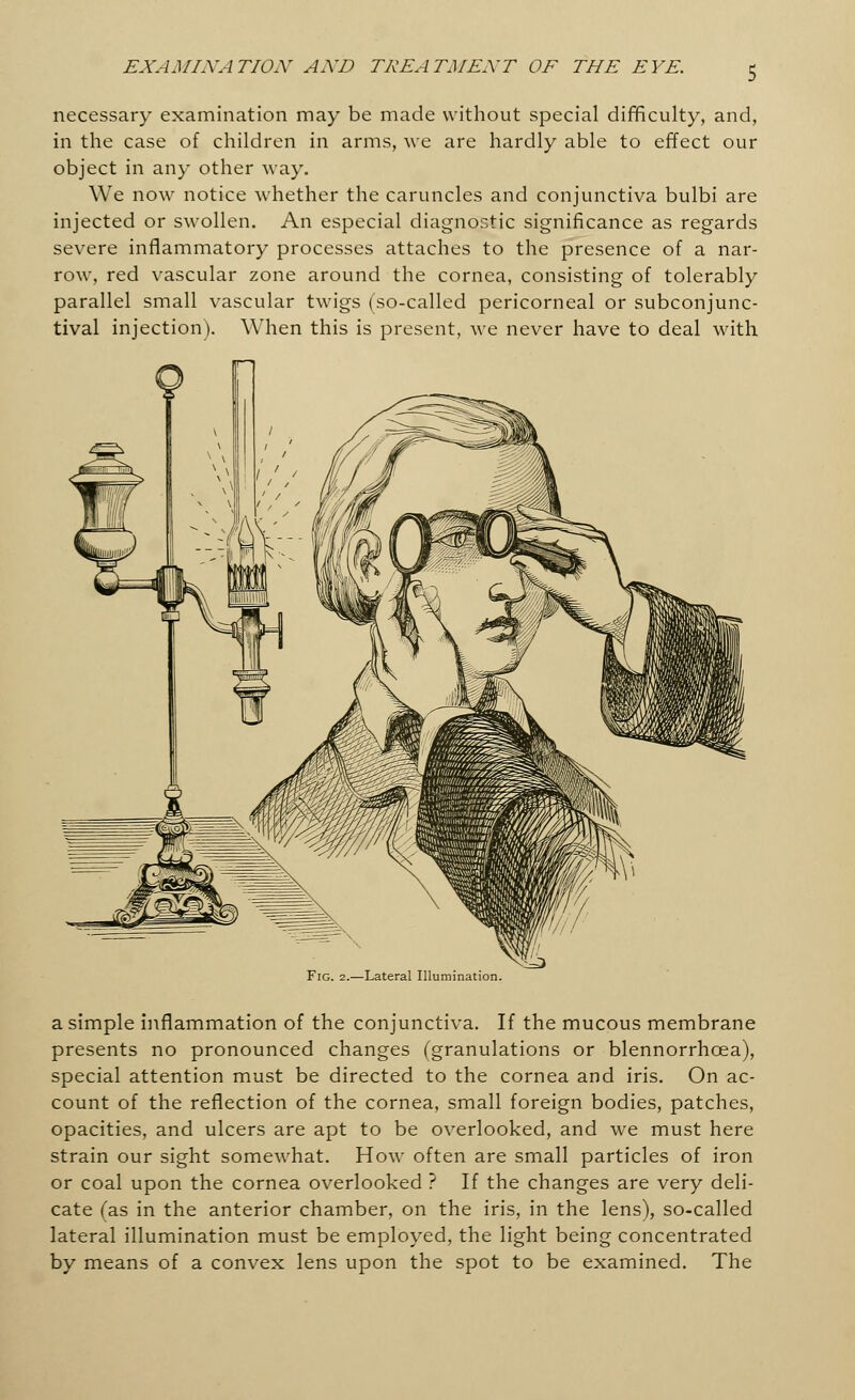 necessary examination may be made without special difficulty, and, in the case of children in arms, we are hardly able to effect our object in any other way. We now notice whether the caruncles and conjunctiva bulbi are injected or swollen. An especial diagnostic significance as regards severe inflammatory processes attaches to the presence of a nar- row, red vascular zone around the cornea, consisting of tolerably parallel small vascular twigs (so-called pericorneal or subconjunc- tival injection). When this is present, we never have to deal with Fig. 2.—Lateral Illumination. a simple inflammation of the conjunctiva. If the mucous membrane presents no pronounced changes (granulations or blennorrhcea), special attention must be directed to the cornea and iris. On ac- count of the reflection of the cornea, small foreign bodies, patches, opacities, and ulcers are apt to be overlooked, and we must here strain our sight somewhat. How often are small particles of iron or coal upon the cornea overlooked ? If the changes are very deli- cate (as in the anterior chamber, on the iris, in the lens), so-called lateral illumination must be employed, the light being concentrated by means of a convex lens upon the spot to be examined. The