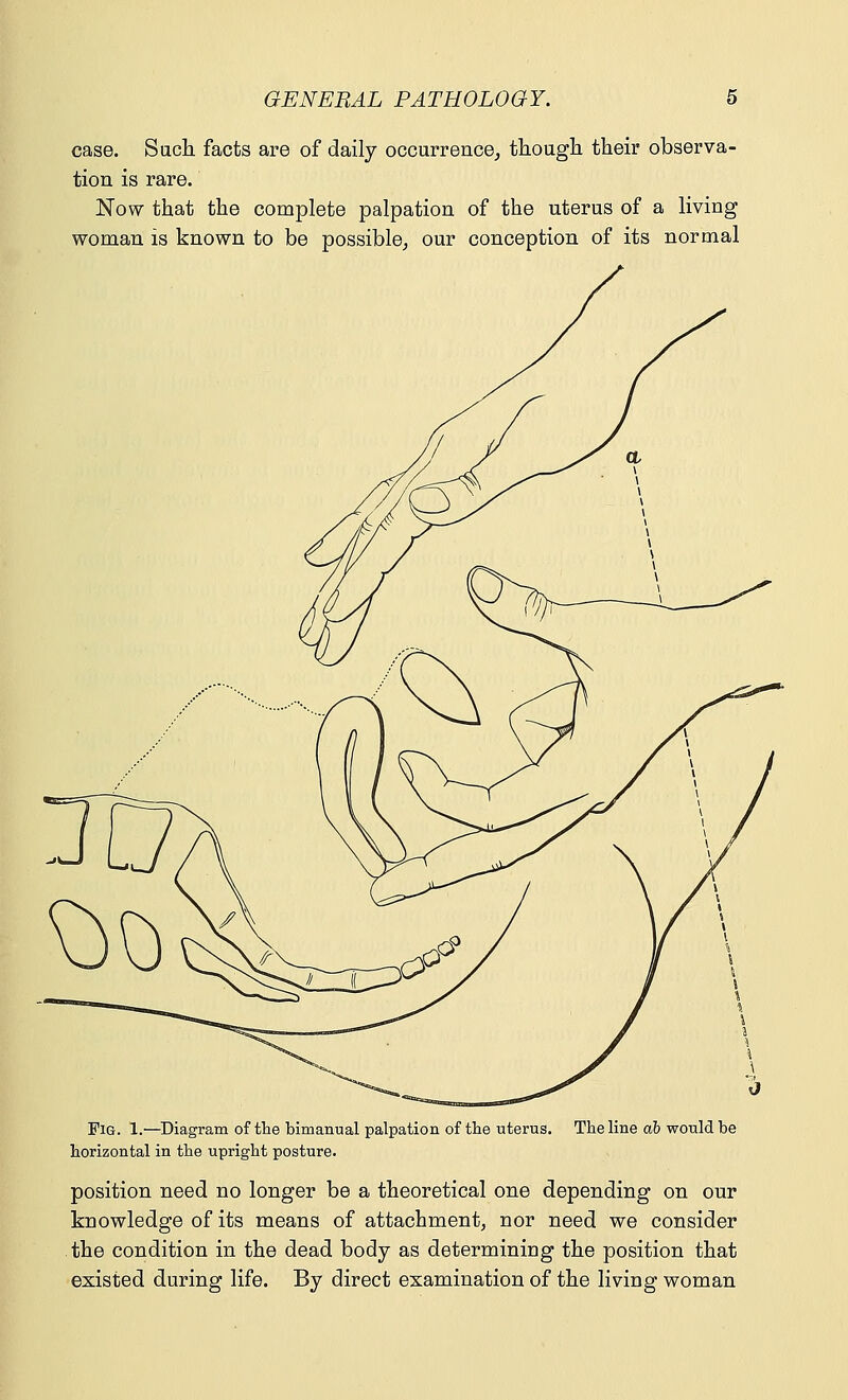 case. Such facts are of daily occurrence, though, their observa- tion is rare. Now that the complete palpation of the uterus of a living woman is known to be possible, our conception of its normal Fig. 1.—Diagram of the bimanual palpation of the uterus. The line ab would be horizontal in the upright posture. position need no longer be a theoretical one depending on our knowledge of its means of attachment, nor need we consider the condition in the dead body as determining the position that existed during life. By direct examination of the living woman