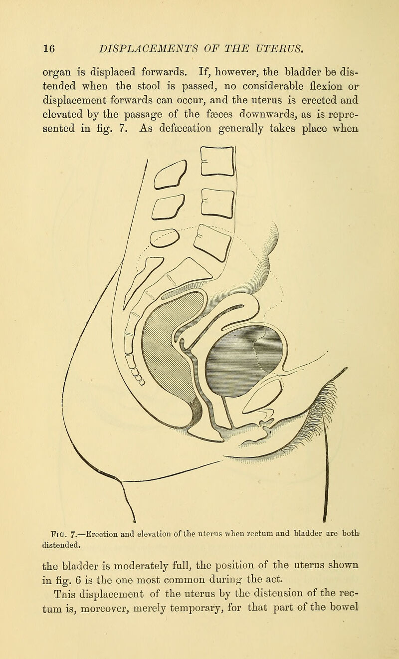 organ is displaced forwards. If, however, the bladder be dis- tended when the stool is passed, no considerable flexion or displacement forwards can occur, and the uterus is erected and elevated by the passage of the faeces downwards, as is repre- sented in fig. 7. As defsecation generally takes place when Fig. 7.—Erection and elevation of the uterus when rectum and bladder are both distended. the bladder is moderately full, the position of the uterus shown in fig. 6 is the one most common during the act. This displacement of the uterus by the distension of the rec- tum is, moreover, merely temporary, for that part of the bowel