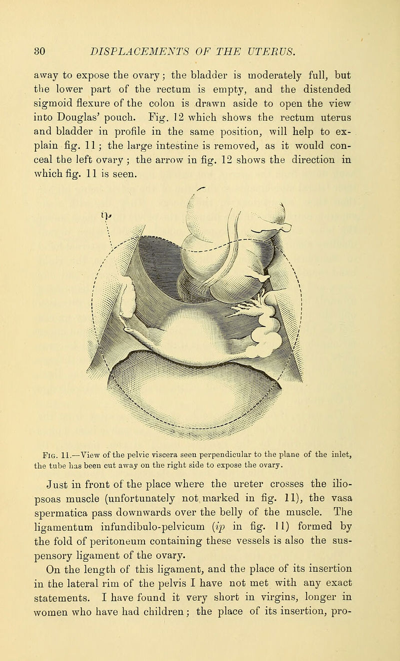 away to expose the ovary • the bladder is moderately full, but the lower part of the rectum is empty, and the distended sigmoid flexure of the colon is drawn aside to open the view into Douglas' pouch. Fig. 12 which shows the rectum uterus and bladder in profile in the same position, will help to ex- plain fig. 11; the large intestine is removed, as it would con- ceal the left ovary ; the arrow in fig. 12 shows the direction in which fig. 11 is seen. Fig. 11.—View of the pelvic viscera seen perpendicular to the plane of the inlet, the tube has been cut away on the right side to expose the ovary. Just in front of the place where the ureter crosses the ilio- psoas muscle (unfortunately not marked in fig. 11), the vasa spermatica pass downwards over the belly of the muscle. The ligamentum infundibulo-pelvicum (ip in fig. 11) formed by the fold of peritoneum containing these vessels is also the sus- pensory ligament of the ovary. On the length of this ligament, and the place of its insertion in the lateral rim of the pelvis I have not met with any exact statements. I have found it very short in virgins, longer in women who have had children; the place of its insertion, pro-