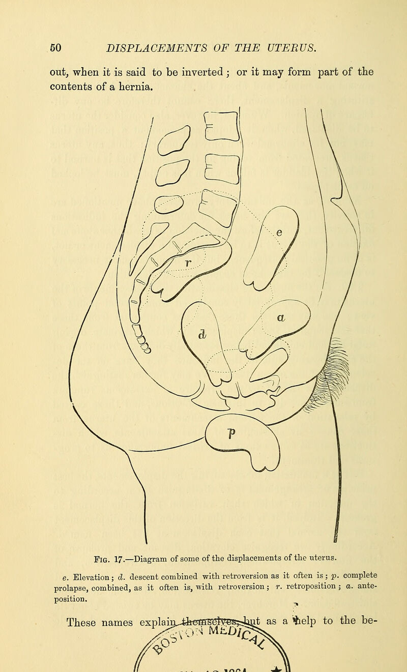 out, when it is said to be inverted ; or it may form part of the contents of a hernia. Pig. 17.—Diagram of some of the displacements of the uterus. e. Elevation; d. descent combined with retroversion as it often is; p. complete prolapse, combined, as it often is, with retroversion; r. retroposition; a. ante- position. These names explain^feefflSS&eBjAnt as a %elp to the be-
