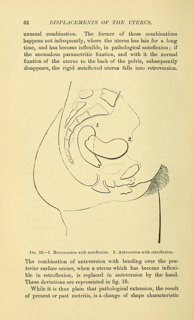 unusual combination. The former of these combinations happens not infrequently, where the uterus has lain for a long time, and has become inflexible, in pathological anteflexion • if the anomalous parametritic fixation, and with it the normal fixation of the uterus to the back of the pelvis, subsequently disappears, the rigid antefiexed uterus falls into retroversion. Fig. 18.—1. Ketroversion with anteflexion. 2. Anteversion with retroflexion. The combination of anteversion with bending over the pos- terior surface occurs, when a uterus which has become inflexi- ble in retroflexion, is replaced in anteversion by the hand. These deviations are represented in fig. 18. While it is thus plain that pathological extension, the result of present or past metritis, is a change of shape characteristic