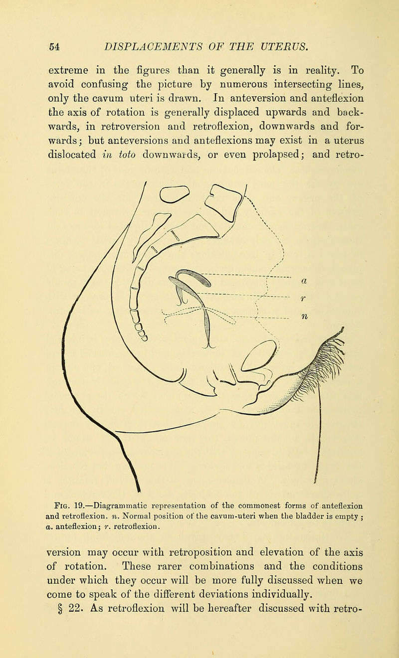 extreme in the figures than it generally is in reality. To avoid confusing the picture by numerous intersecting lines, only the cavum uteri is drawn. In anteversion and anteflexion the axis of rotation is generally displaced upwards and back- wards, in retroversion and retroflexion, downwards and for- wards ; but anteversions and anteflexions may exist in a uterus dislocated in toto downwards, or even prolapsed; and retro- C^-V=3 Fig. 19.—Diagrammatic representation of the commonest forms of anteflexion and retroflexion, n. Normal position of the cavum-uteri when the bladder is empty ; a. anteflexion; r. retroflexion. version may occur with retroposition and elevation of the axis of rotation. These rarer combinations and the conditions under which they occur will be more fully discussed when we come to speak of the different deviations individually. § 22. As retroflexion will be hereafter discussed with retro-