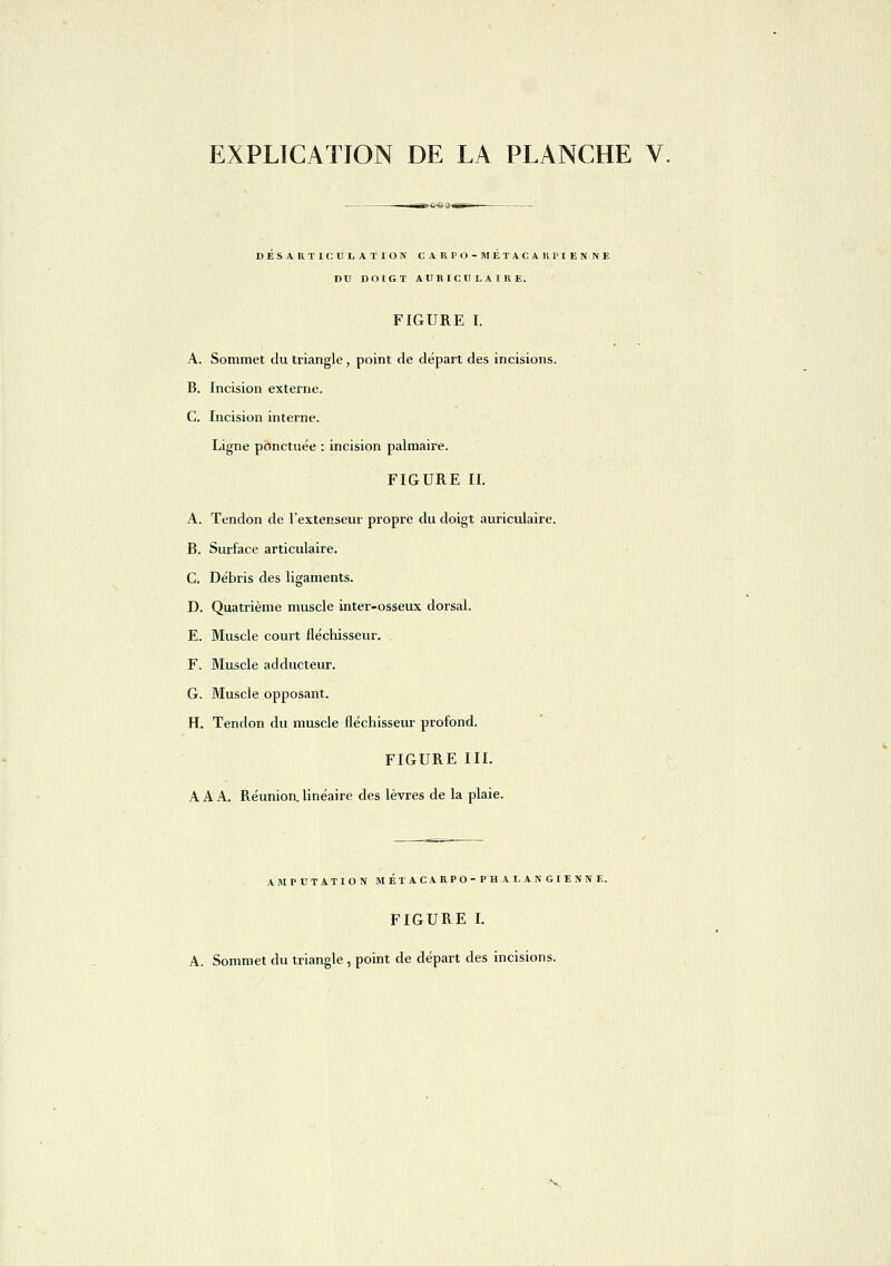 DESARTICULATION CARPO-METACARPIENNE DU DOIGT AURICULAIRE. FIGURE I. A. Sommet du triangle, point de départ des incisions. B. Incision externe, C. Incision interne. Ligne ponctuée : incision palmaire. FIGURE II. A. Tendon de l'extenseur propre du doigt auriculaire. B. Surface articulaire. C. Débris des ligaments. D. Quatrième muscle inter-osseux dorsal. E. Muscle court fléchisseur. F. Muscle adducteur. G. Muscle opposant. H. Tendon du muscle fléchisseur profond. FIGURE III. A A A. Réunion, linéaire des lèvres de la plaie. AMPUTATION M ÉTAC A RPO-PHAL ANCIENNE. FIGURE I. A. Sommet du triangle , point de départ des incisions.