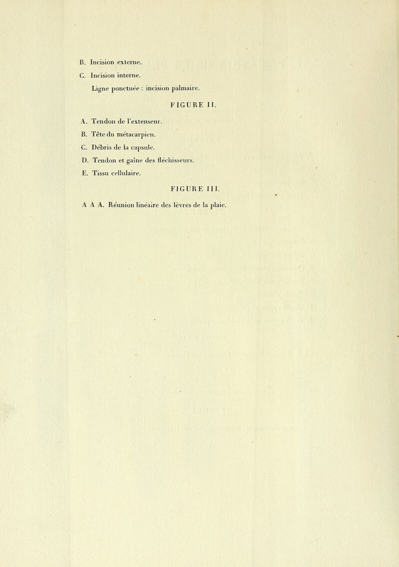 B. Incision externe. C. Incision interne. Ligne ponctuée : incision palmaire. FIGURE II. A. Tendon de l'extenseur. B. Tête du métacarpien. C. Débris de la capsule. D. Tendon et gaîne des fléchisseurs. E. Tissu cellulaire. FIGURE III.