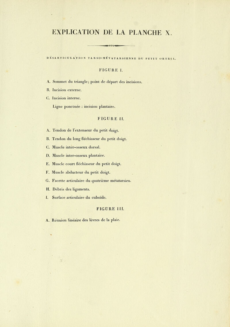 DESARTICULATION T A R S O-M E T A T A R S I E NN E DU PETIT ORTEIL. FIGURE r. A. Sommet du triangle; point de départ des incisions. B. Incision externe. C. Incision interne. Ligne ponctuée : incision plantaire. FIGURE II. A. Tendon de l'extenseur du petit doigt. B. Tendon du long fléchisseur du petit doigt. C. Muscle inter-osseux dorsal. D. Muscle inter-osseux plantaire. E. Muscle court fléchisseur du petit doigt. F. Muscle abducteur du petit doigt. G. Facette articulaire du quatrième métatarsien. H. Débris des ligaments. I. Surface articulaire du cuboïde. FIGURE III.