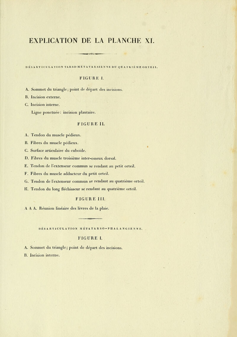 DESARTICULATION TARSO-METATA R SIEN NE DU QUATRIEME ORTEIL. FIGURE I. A. Sommet du triangle ; point de départ des incisions. B. Incision externe. C. Incision interne. Ligne ponctuée : incision plantaire. FIGURE II, A. Tendon du muscle pédieux. B. Fibres du muscle pédieux. C. Surface articulaire du cuboïde. D. Fibres du muscle troisième inter-osseux dorsal. E. Tendon de l'extenseur commun se rendant au petit orteil. F. Fibres du muscle adducteur du petit orteil. G. Tendon de l'extenseur commun se rendant au quatrième orteil. H. Tendon du long fléchisseur se rendant au quatrième orteil. FIGURE III. A A A. Réunion linéaire des lèvres de la plaie. DESARTICULATION METATARSO-PIIALANGIENNE. FIGURE I. A. Sommet du triangle ; point de départ des incisions. B. Incision interne.