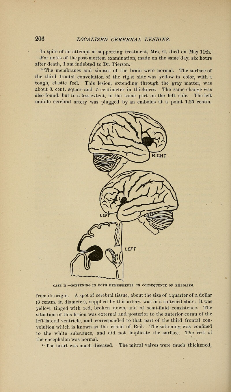 In spite of an attempt at supporting treatment, Mrs. Gr. died on May 11th. •For notes of the post-mortem examination, made on the same day, six hours after death, I am indebted to Dr. Pierson. The membranes and sinuses of the brain were normal. The surface of the third frontal convolution of the right side was yellow in color, with a tough, elastic feel. This lesion, extending through the gray matter, was about 3. cent, square and .5 centimeter in thickness. The same change was also found, but to a less extent, in the same part on the left side. The left middle cerebral artery was plugged by an embolus at a point 1.25 centm. CASE II.—SOFTENING IN BOTH HEMISPHERES, IN CONSEQUENCE OF EMBOLISM. from its origin. A spot of cerebral tissue, about the size of a quarter of a dollar (3 centm. in diameter), supplied by this artery, was in a softened state ; it was yellow, tinged with red, broken down, and of semi-fluid consistence. The situation of this lesion was external and posterior to the anterior cornu of the left lateral ventricle, and corresponded to that part of the third frontal con- volution which is known as the island of Reil. The softening was confined to the white substance, and did not implicate the surface. The rest of the cncephalon was normal. The licart was much diseased. The mitral valves were much thickened,