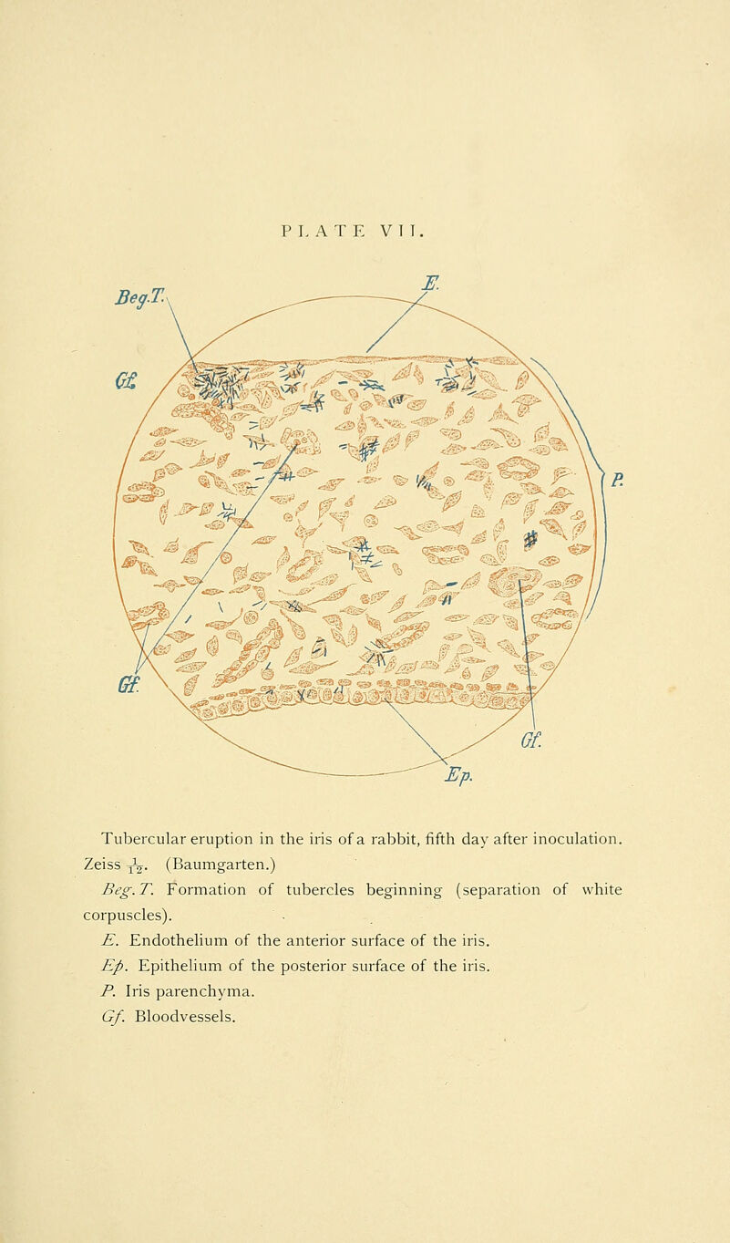 PLATE V T T, Tubercular eruption in the iris of a rabbit, fifth day after inoculation. Zeiss '^^. (Baumgarten.) Beg. T. Formation of tubercles beginning (separation of white corpuscles). E. Endothelium of the anterior surface of the iris. Ep. Epithelium of the posterior surface of the iris. P. Iris parenchyma. Gf. Bloodvessels.