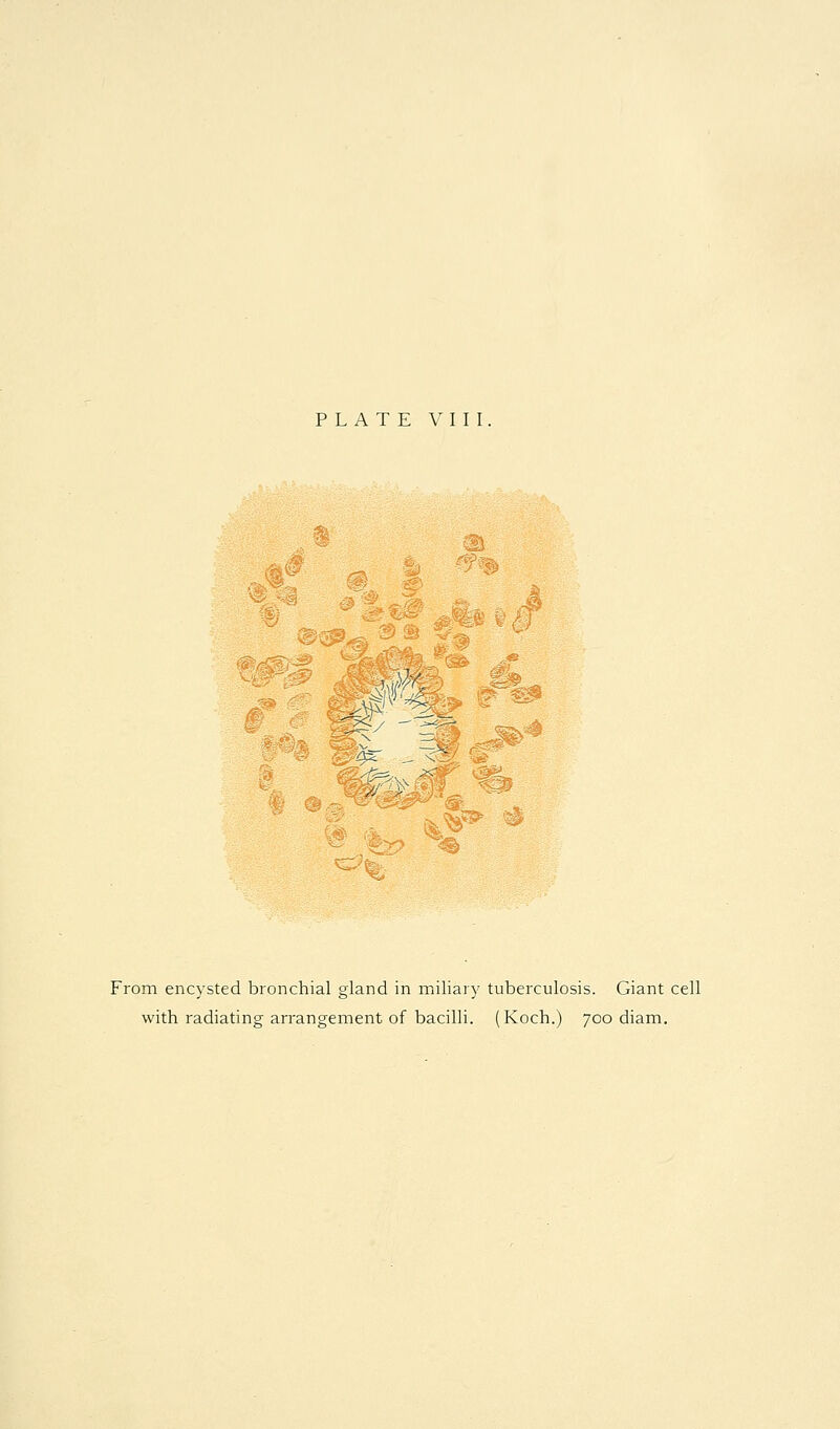 (|^^ ^ From encysted bronchial gland in miliary tuberculosis. Giant cell with radiating arrangement of bacilli. (Koch.) 700 diam.