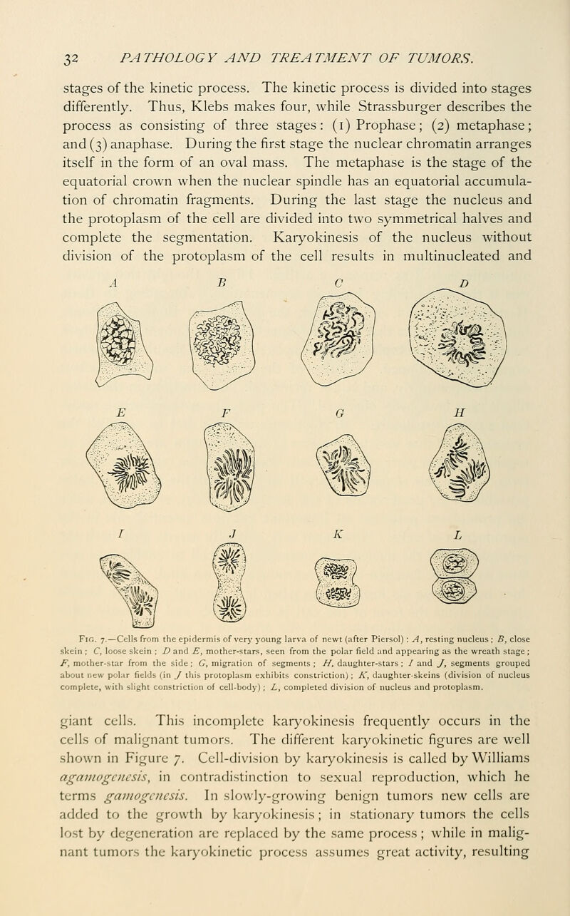 stages of the kinetic process. The kinetic process is divided into stages differently. Thus, Klebs makes four, while Strassburger describes the process as consisting of three stages: (i) Prophase; (2) metaphase; and (3) anaphase. During the first stage the nuclear chromatin arranges itself in the form of an oval mass. The metaphase is the stage of the equatorial crown when the nuclear spindle has an equatorial accumula- tion of chromatin fragments. During the last stage the nucleus and the protoplasm of the cell are divided into two symmetrical halves and complete the segmentation. Karyokinesis of the nucleus without division of the protoplasm of the cell results in multinucleated and K Fig. 7.—Cells from the epidermis of very young larva of newt (after Piersol) : A, resting nucleus ; 5, close skein ; C, loose skein ; D and E, mother-stars, seen from the polar field and appearing as the wreath stage ; F, mother-star from the side ; G, migration of segments ; H, daughter-stars ; / and J, segments grouped about new polar fields (in J this protoplasm exhibits constriction); K, daughter-skeins (division of nucleus complete, with slight constriction of cell-body); L, completed division of nucleus and protoplasm. giant cells. This incomplete karyokinesis frequently occurs in the cells of malignant tumors. The different karyokinetic figures are well shown in Figure 7. Cell-division by karyokinesis is called by Williams agamogcnesis, in contradistinction to sexual reproduction, which he terms gainogcnesis. In slowly-growing benign tumors new cells are added to the growth by karyokinesis; in stationary tumors the cells lost by degeneration arc replaced by the same process; while in malig- nant tumors the karyokinetic process assumes great activity, resulting