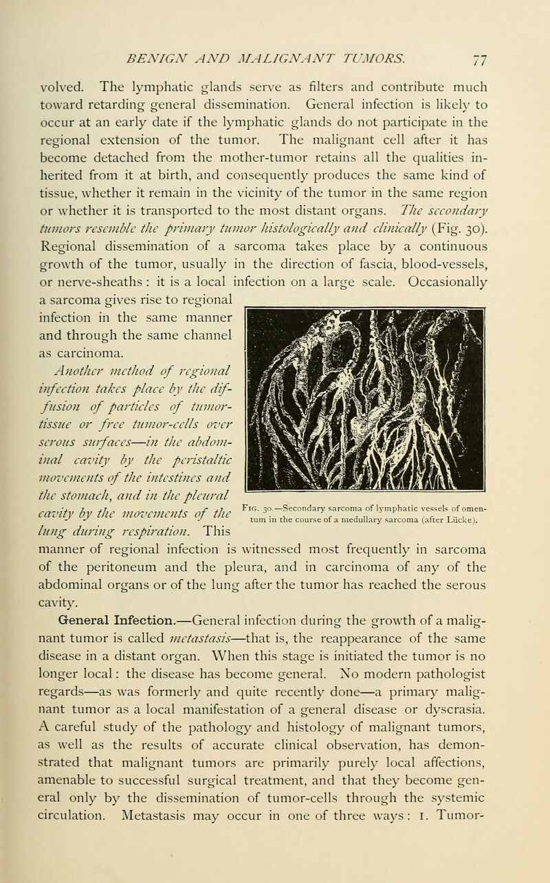 volved. The lymphatic glands serve as filters and contribute much toward retarding general dissemination. General infection is likely to occur at an early date if the lymphatic glands do not participate in the regional extension of the tumor. The malignant cell after it has become detached from the mother-tumor retains all the qualities in- herited from it at birth, and consequently produces the same kind of tissue, whether it remain in the vicinity of the tumor in the same region or whether it is transported to the most distant organs. TJic secondary tumors resemble the primary tumor histologically and clinically (Fig. 30). Regional dissemination of a sarcoma takes place by a continuous growth of the tumor, usually in the direction of fascia, blood-vessels, or nerve-sheaths : it is a local infection on a large scale. Occasionally a sarcoma gives rise to regional infection in the same manner and through the same channel as carcinoma. Another method of regional infection takes place by the dif- fusion of particles of tiimor- tissue or free tumor-cells over serous surfaces—in the abdom- inal cavity by the peristaltic movements of the intestines and the stomach, and in the pleural cavity by the movements of the lung during respiration. This manner of regional infection is witnessed most frequently in sarcoma of the peritoneum and the pleura, and in carcinoma of any of the abdominal organs or of the lung after the tumor has reached the serous cavity. General Infection.—General infection during the growth of a malig- nant tumor is called metastasis—that is, the reappearance of the same disease in a distant organ. When this stage is initiated the tumor is no longer local: the disease has become general. No modern pathologist regards—as was formerly and quite recently done—a primary malig- nant tumor as a local manifestation of a general disease or dyscrasia. A careful study of the pathology and histology of malignant tumors, as well as the results of accurate clinical observation, has demon- strated that malignant tumors are primarily purely local affections, amenable to successful surgical treatment, and that they become gen- eral only by the dissemination of tumor-cells through the systemic circulation. Metastasis may occur in one of three ways: i. Tumor- FiG. 30.—Secondary sarcoma of lymphatic vessels of omen- tum in the course of a medullary sarcoma (after Liicke).